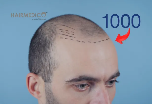 1000-greft-fue-2025