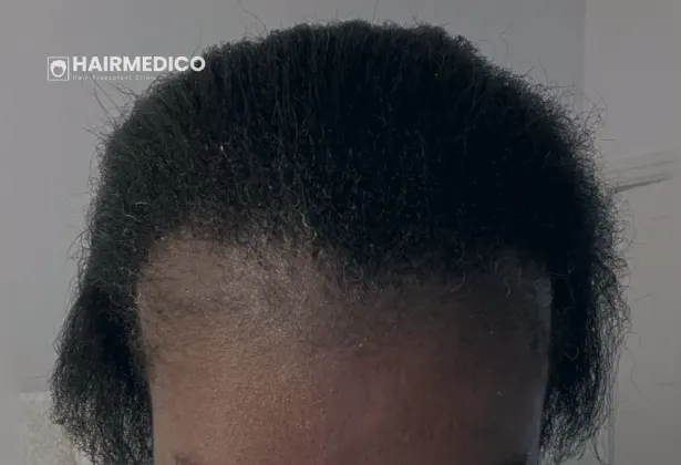 Włosy afro i łysienie bliznowaciejące 2026