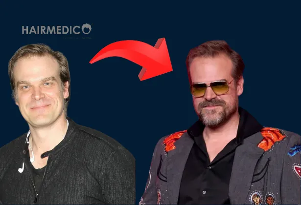 Greffe de cheveux de David Harbour