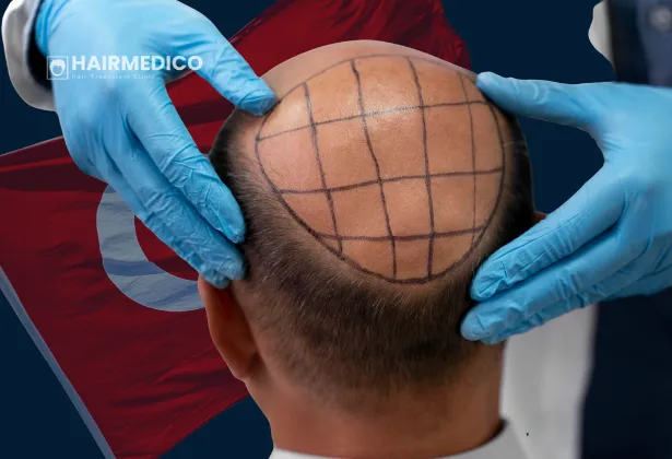 زراعة الشعر بتقنية اقتطاف وحدة البصيلات (FUE) في تركيا: الإجراء والنتائج وفترة النقاهة