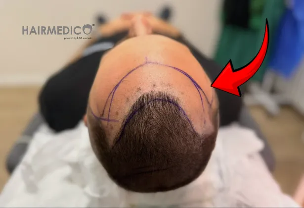 Pourquoi la conception de la ligne frontale définit un résultat naturel