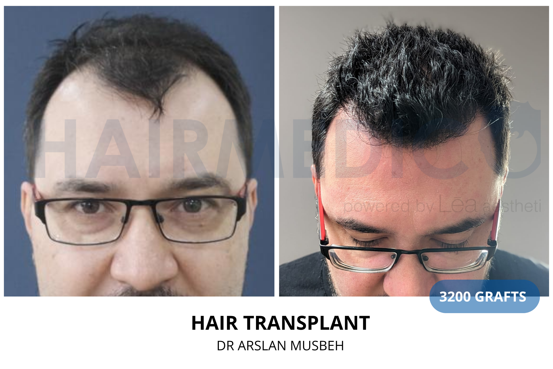 Hair transplant 6-month result — 1175 grafts FUE, Dr. Arslan Musbeh, Hairmedico Istanbul