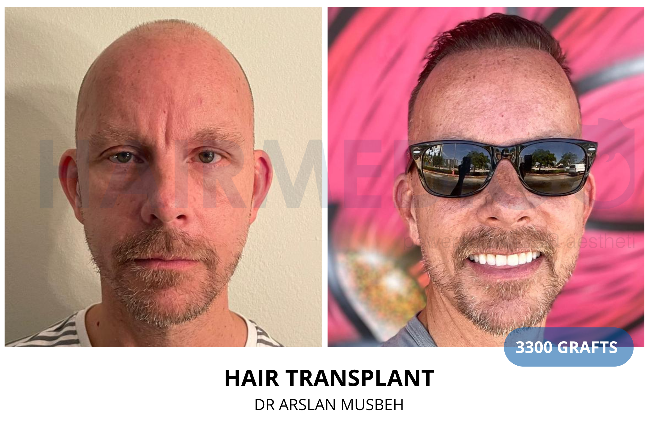 Hair transplant 6-month result — 1225 grafts FUE, Dr. Arslan Musbeh, Hairmedico Istanbul