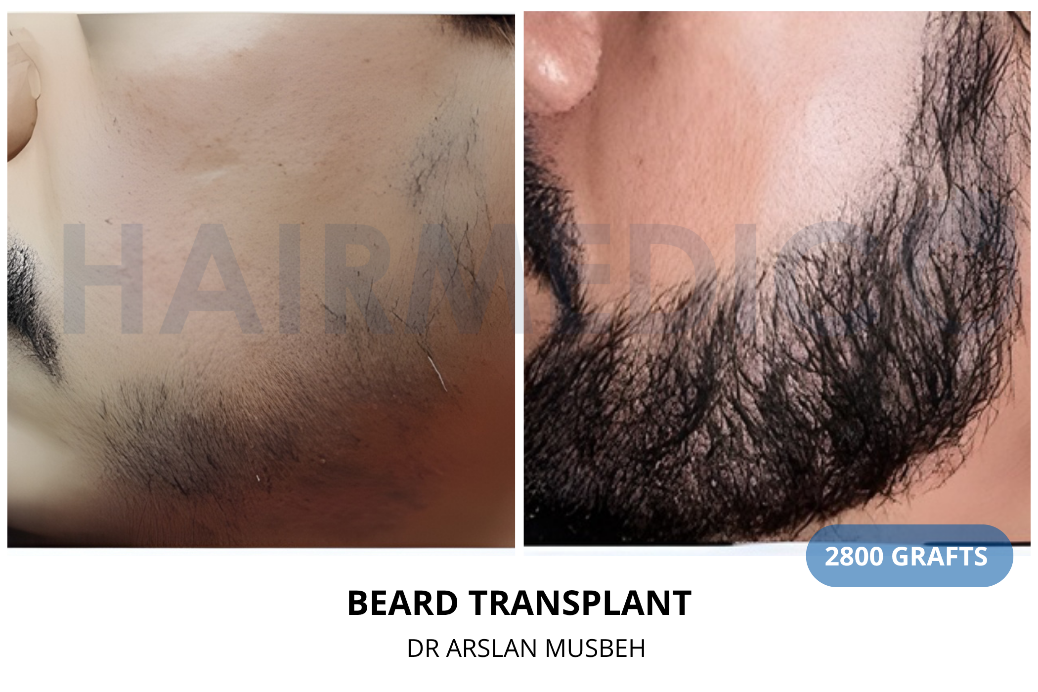 Hair transplant 6-month result — 1275 grafts FUE, Dr. Arslan Musbeh, Hairmedico Istanbul