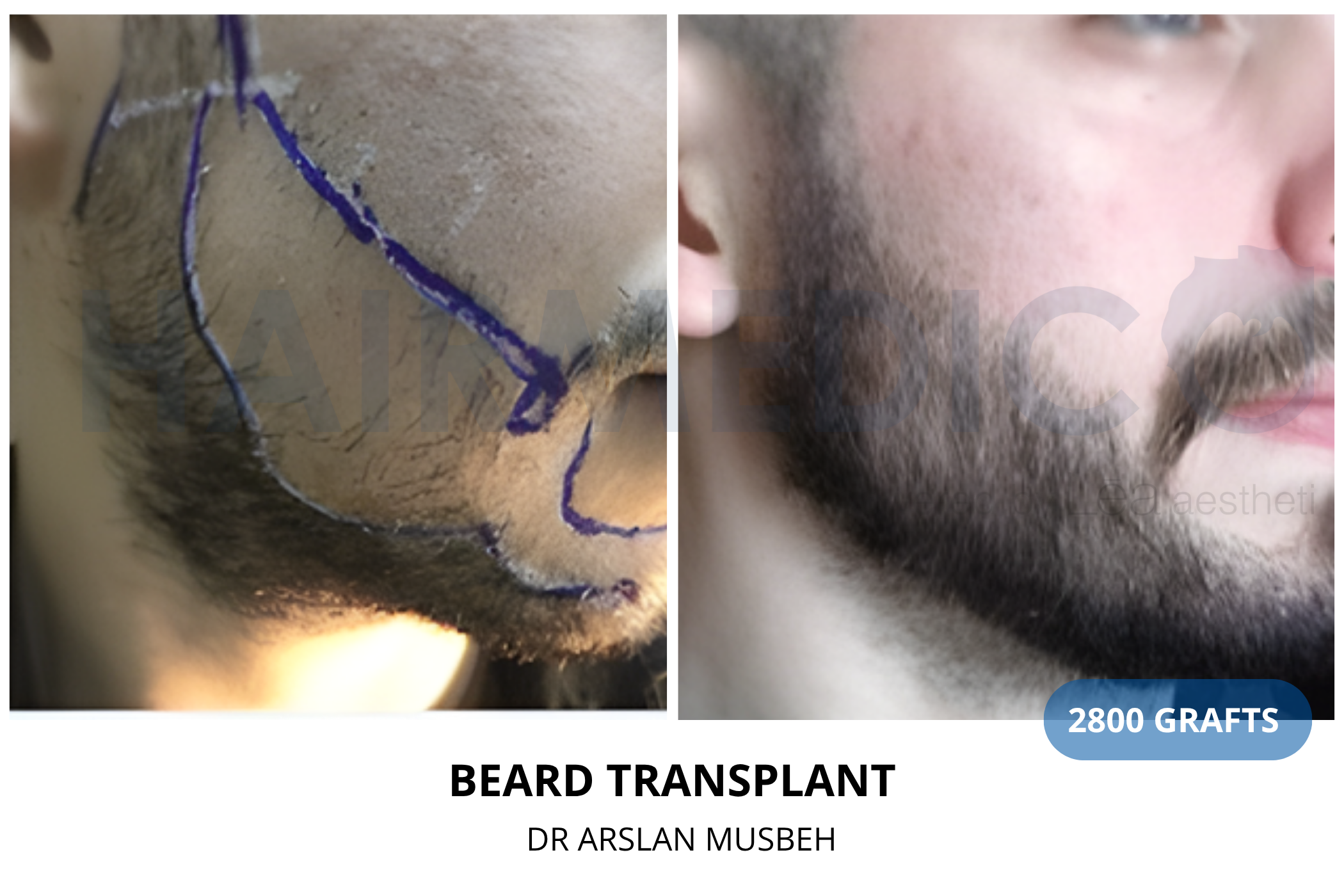 Hair transplant 6-month result — 1300 grafts FUE, Dr. Arslan Musbeh, Hairmedico Istanbul