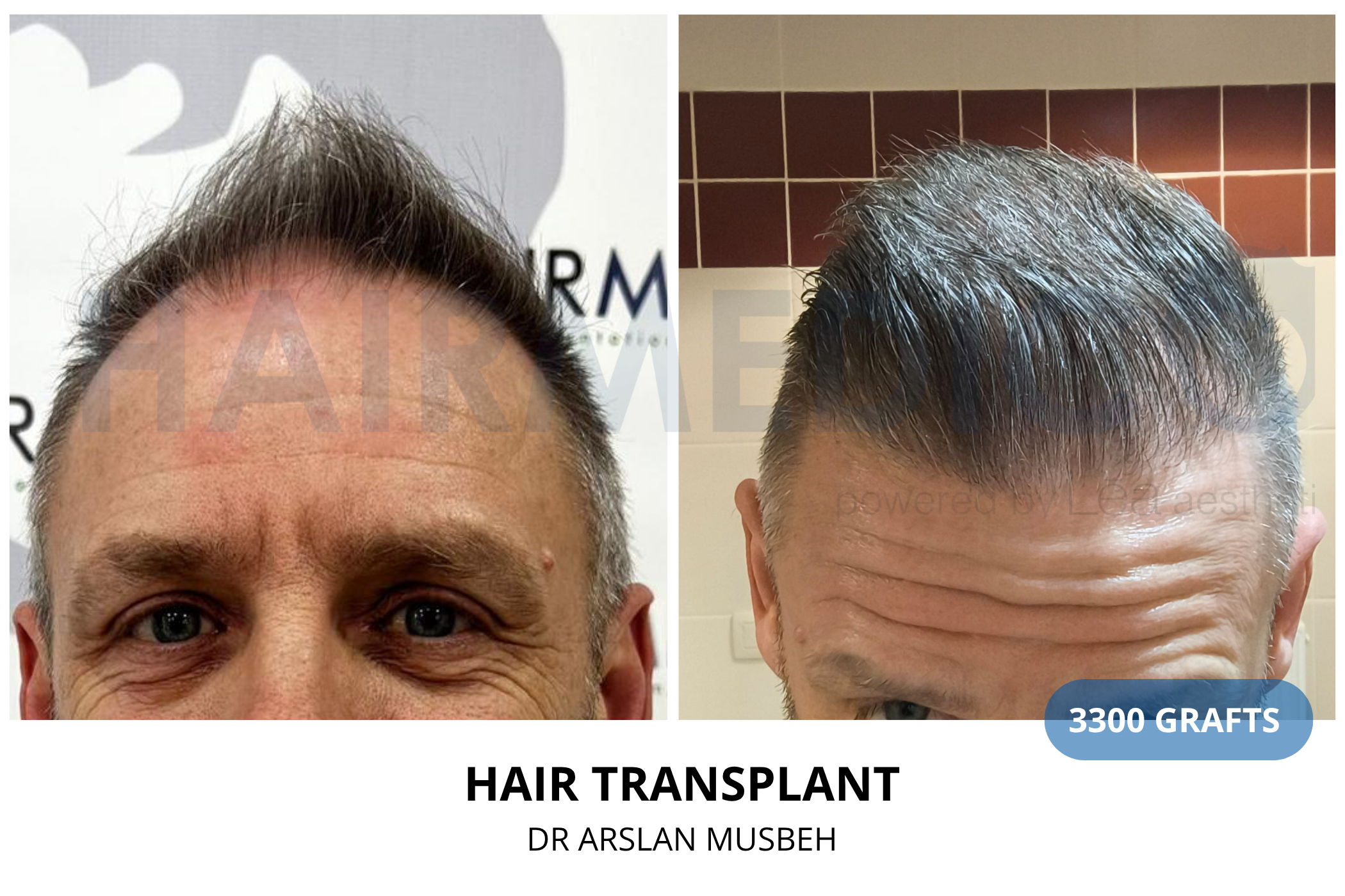 Hair transplant 6-month result — 1325 grafts FUE, Dr. Arslan Musbeh, Hairmedico Istanbul