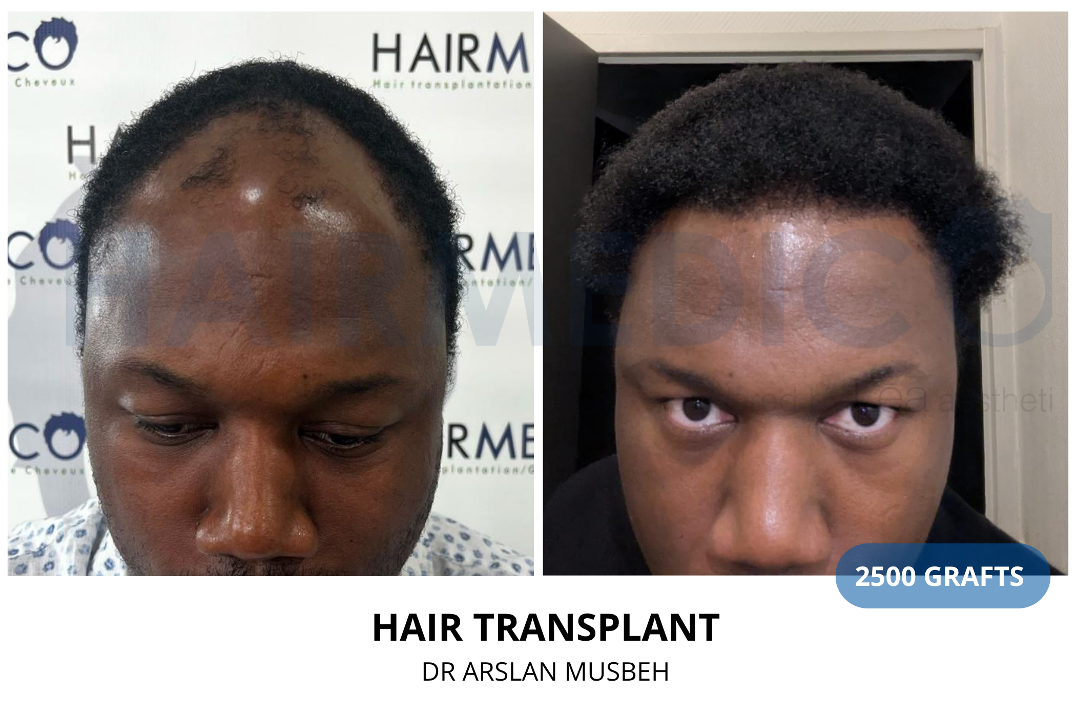 Hair transplant 6-month result — 1375 grafts FUE, Dr. Arslan Musbeh, Hairmedico Istanbul