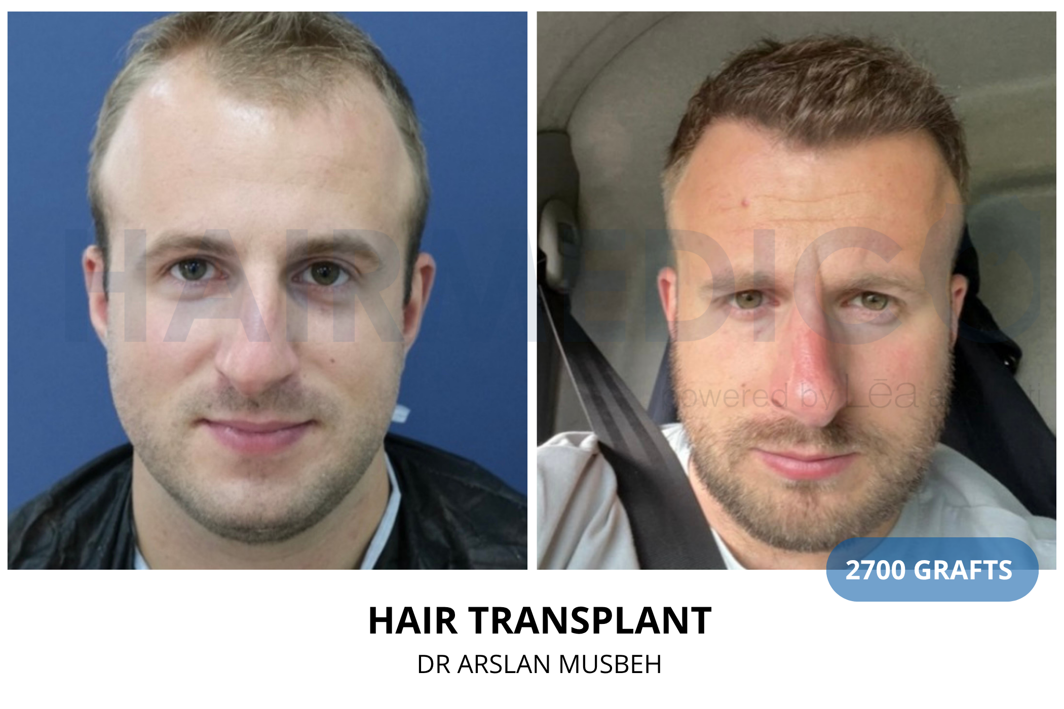 Hair transplant 6-month result — 1400 grafts FUE, Dr. Arslan Musbeh, Hairmedico Istanbul