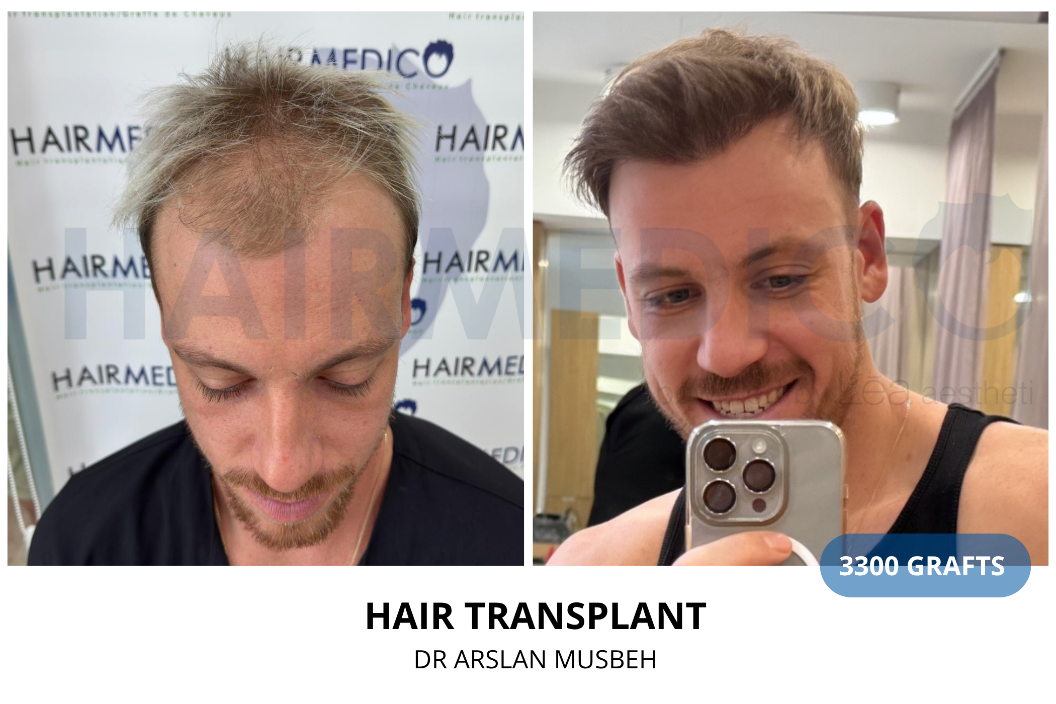 Hair transplant 6-month result — 1425 grafts FUE, Dr. Arslan Musbeh, Hairmedico Istanbul