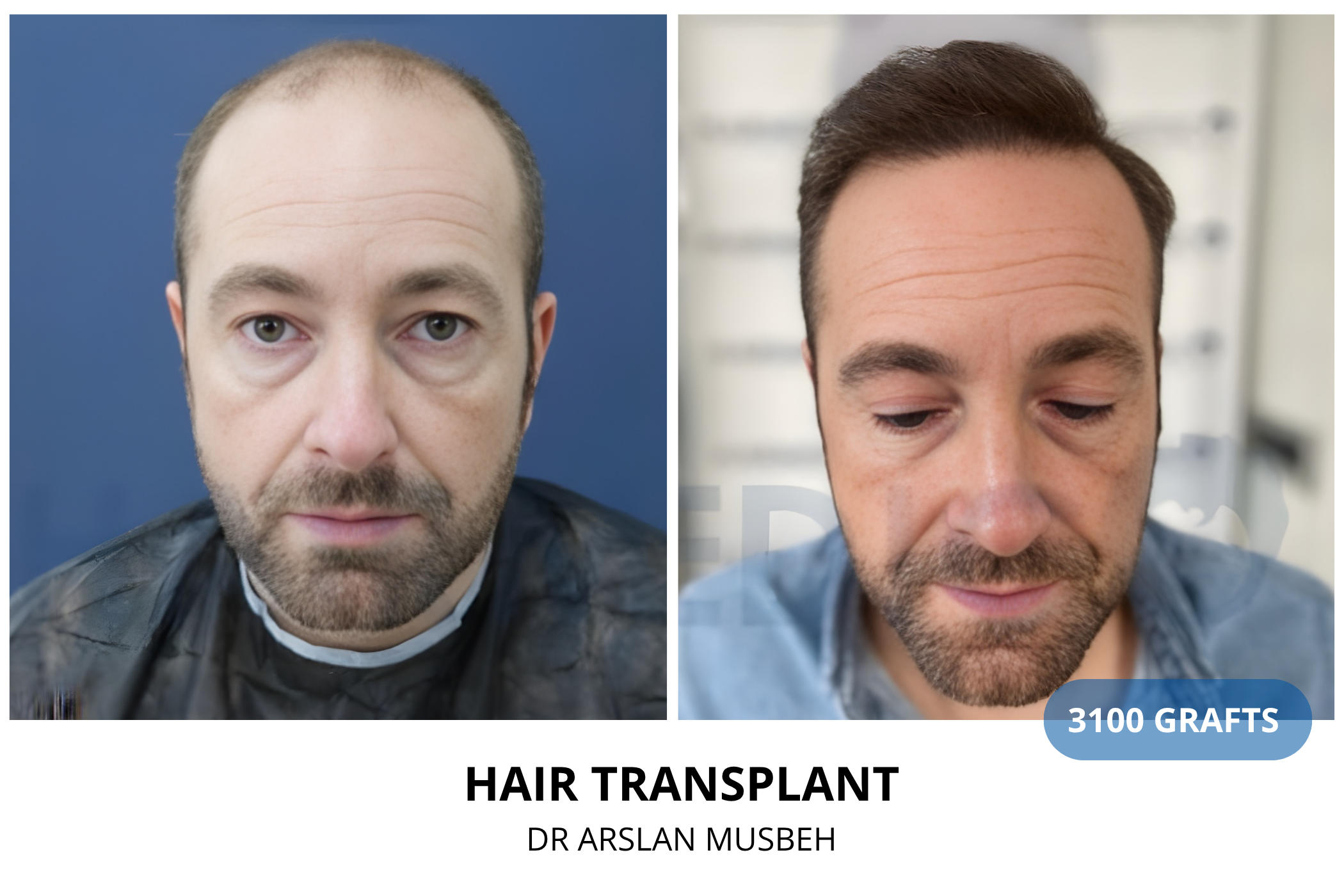 Hair transplant 12-month result — 1500 grafts DHI, Dr. Arslan Musbeh, Hairmedico Istanbul