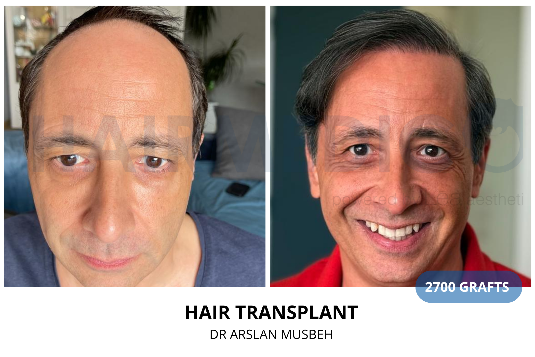 Hair transplant 12-month result — 1525 grafts DHI, Dr. Arslan Musbeh, Hairmedico Istanbul
