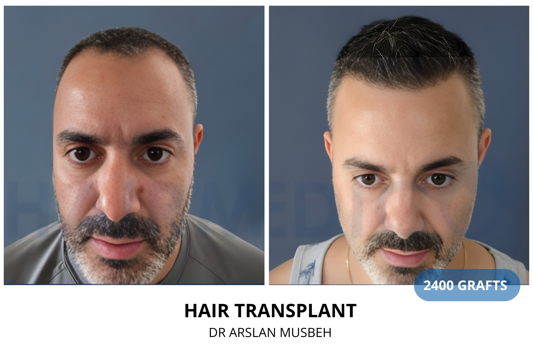 Hair transplant 12-month result — 1550 grafts DHI, Dr. Arslan Musbeh, Hairmedico Istanbul