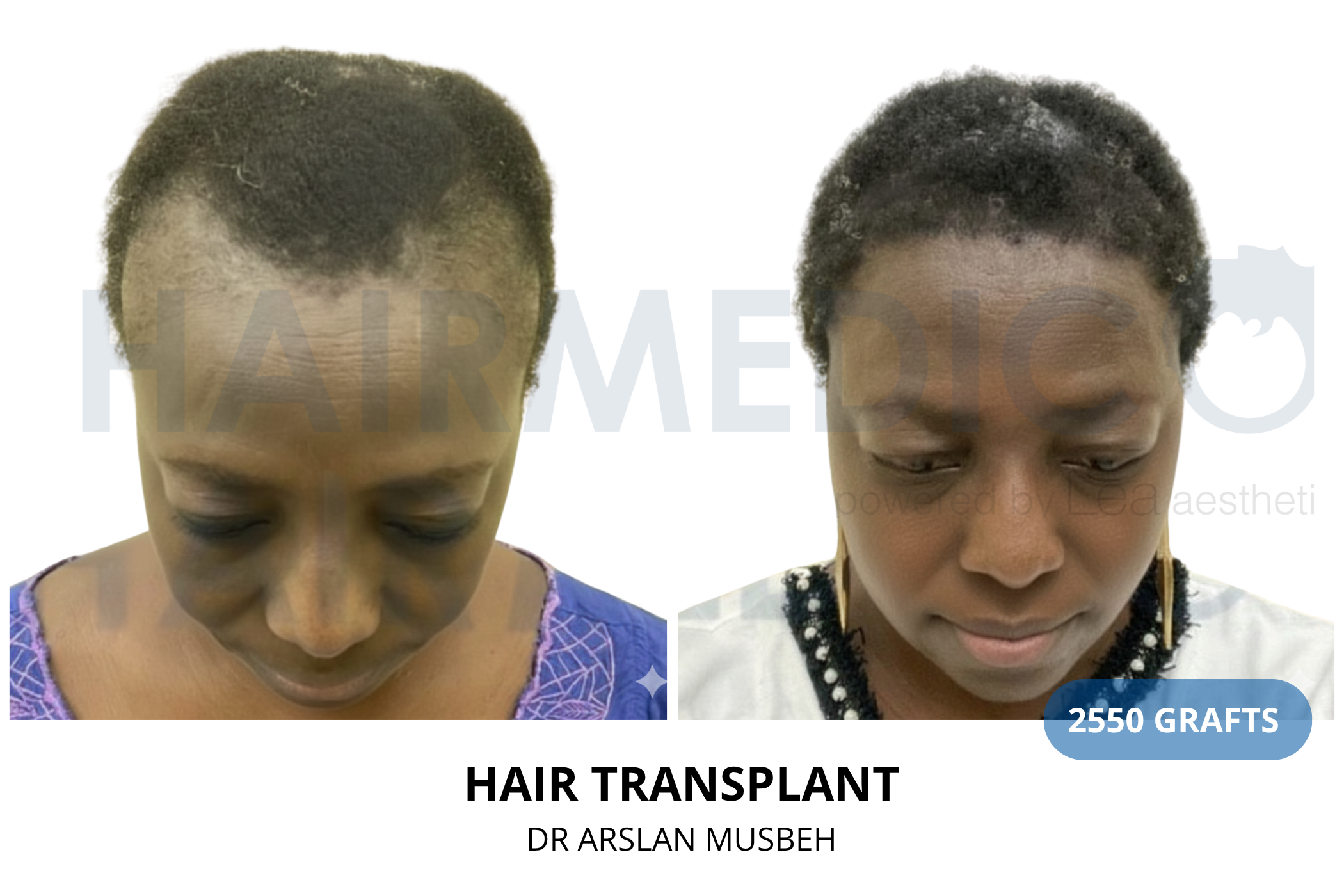 Hair transplant 12-month result — 1575 grafts DHI, Dr. Arslan Musbeh, Hairmedico Istanbul