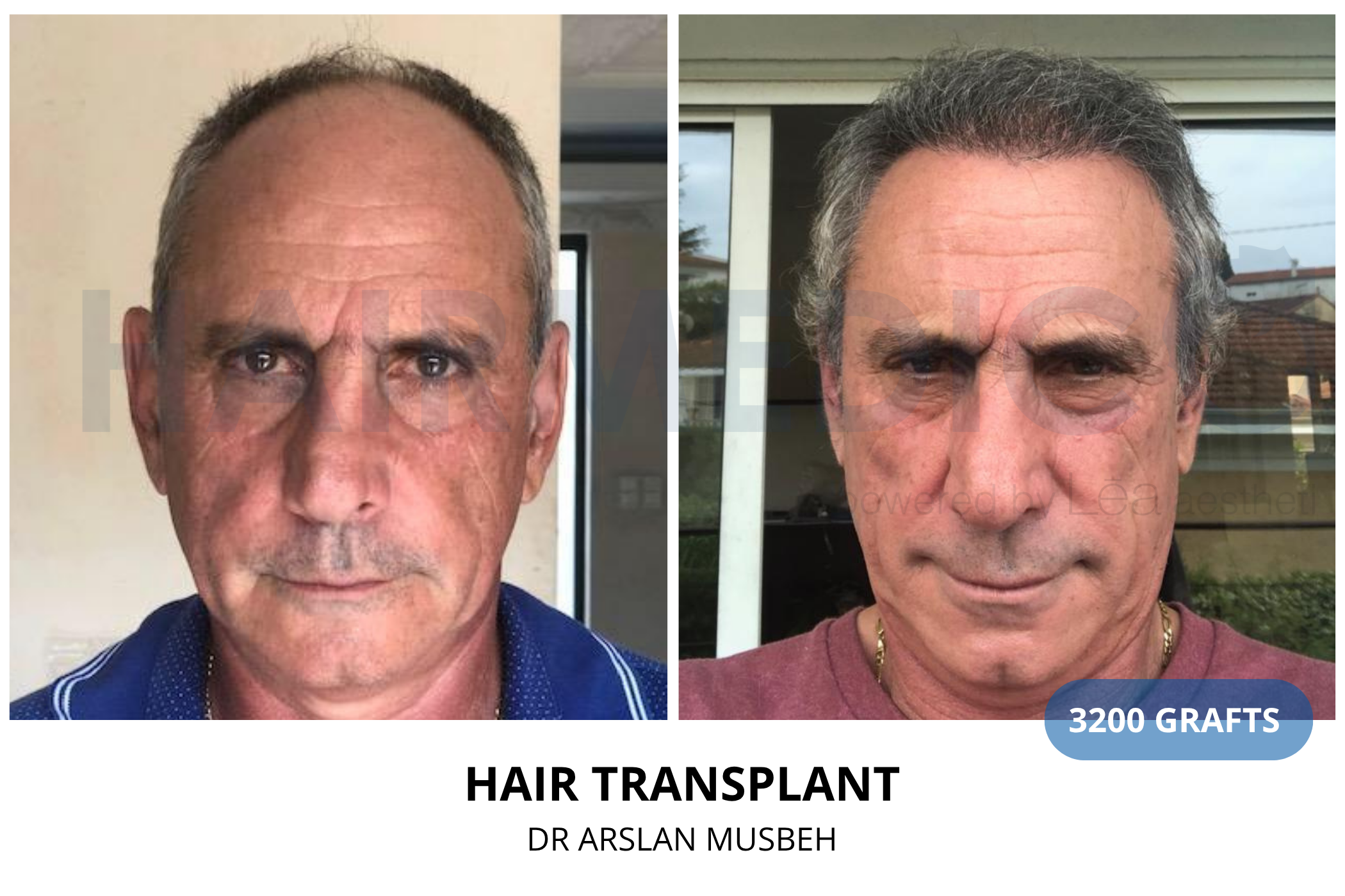 Hair transplant 12-month result — 1650 grafts DHI, Dr. Arslan Musbeh, Hairmedico Istanbul