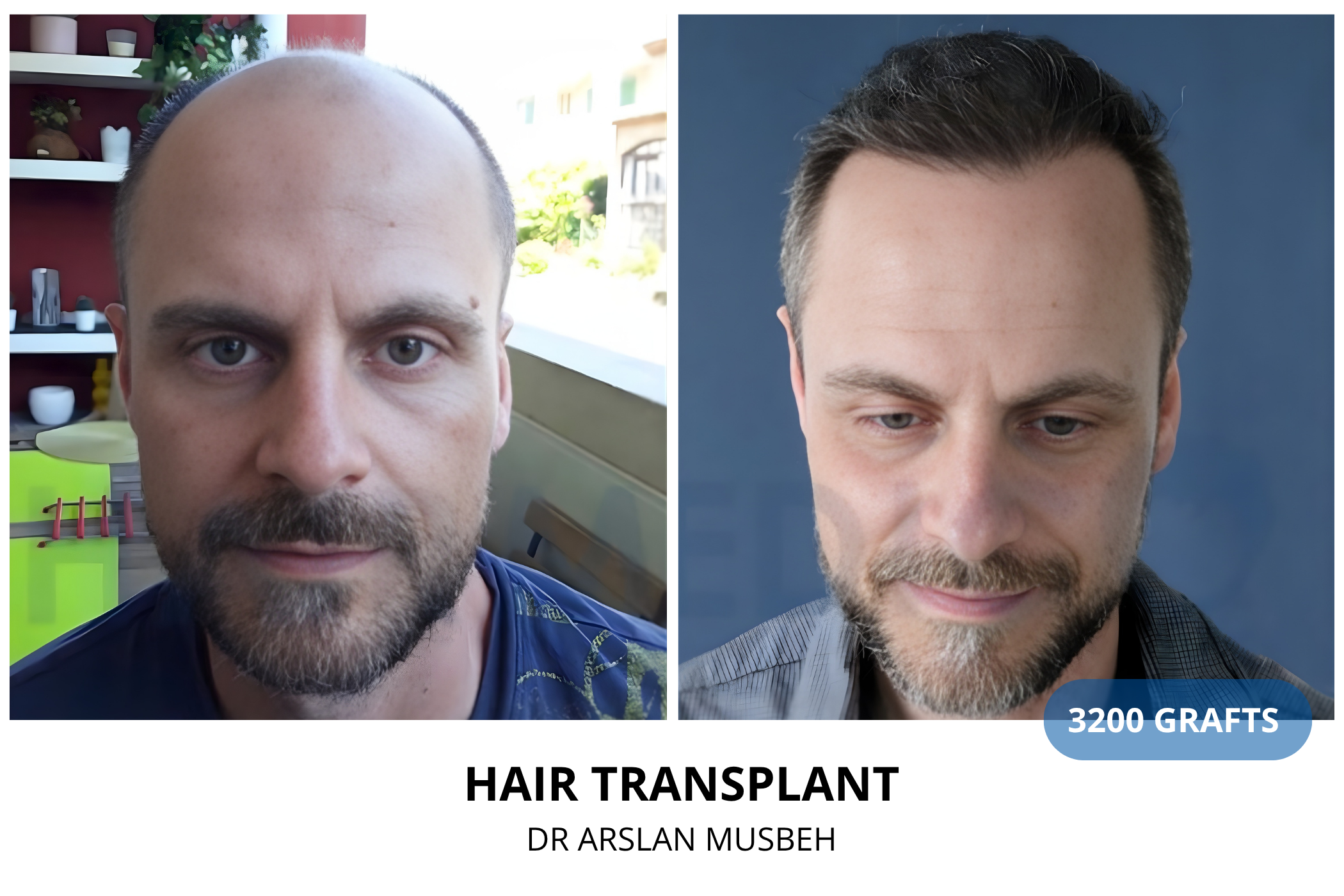 Hair transplant 12-month result — 1675 grafts DHI, Dr. Arslan Musbeh, Hairmedico Istanbul