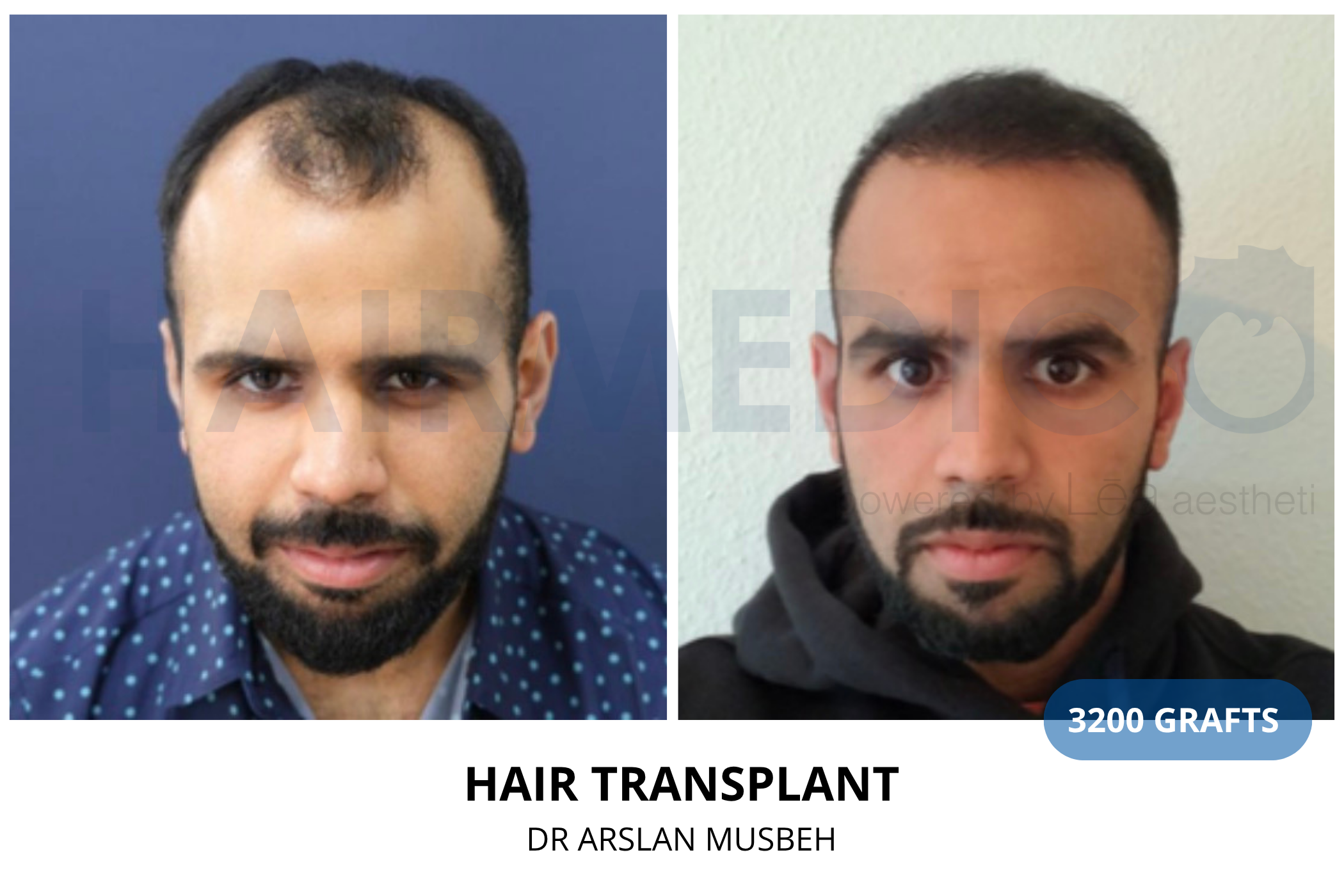 Hair transplant 12-month result — 1700 grafts DHI, Dr. Arslan Musbeh, Hairmedico Istanbul
