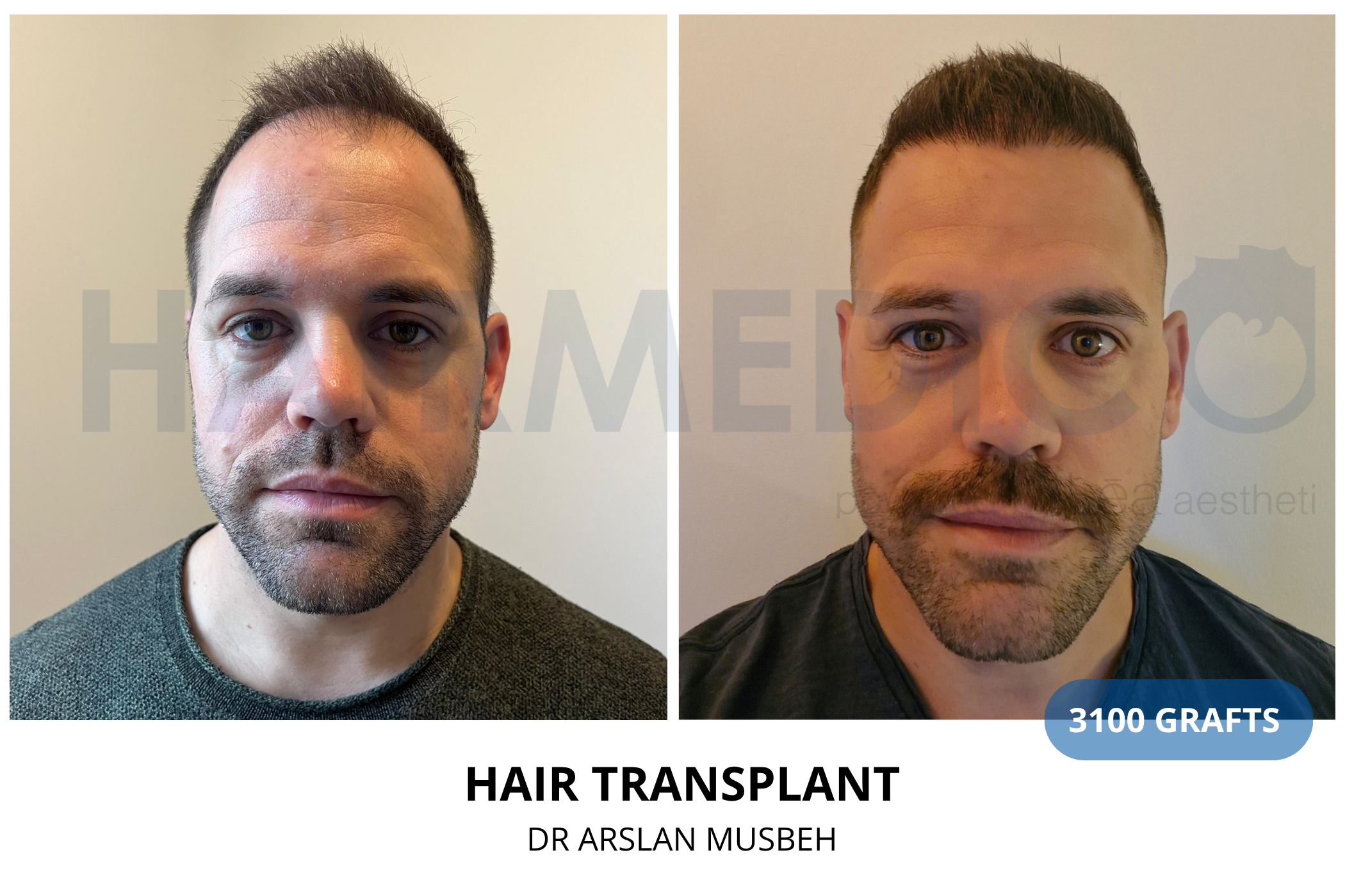 Hair transplant 12-month result — 1775 grafts DHI, Dr. Arslan Musbeh, Hairmedico Istanbul