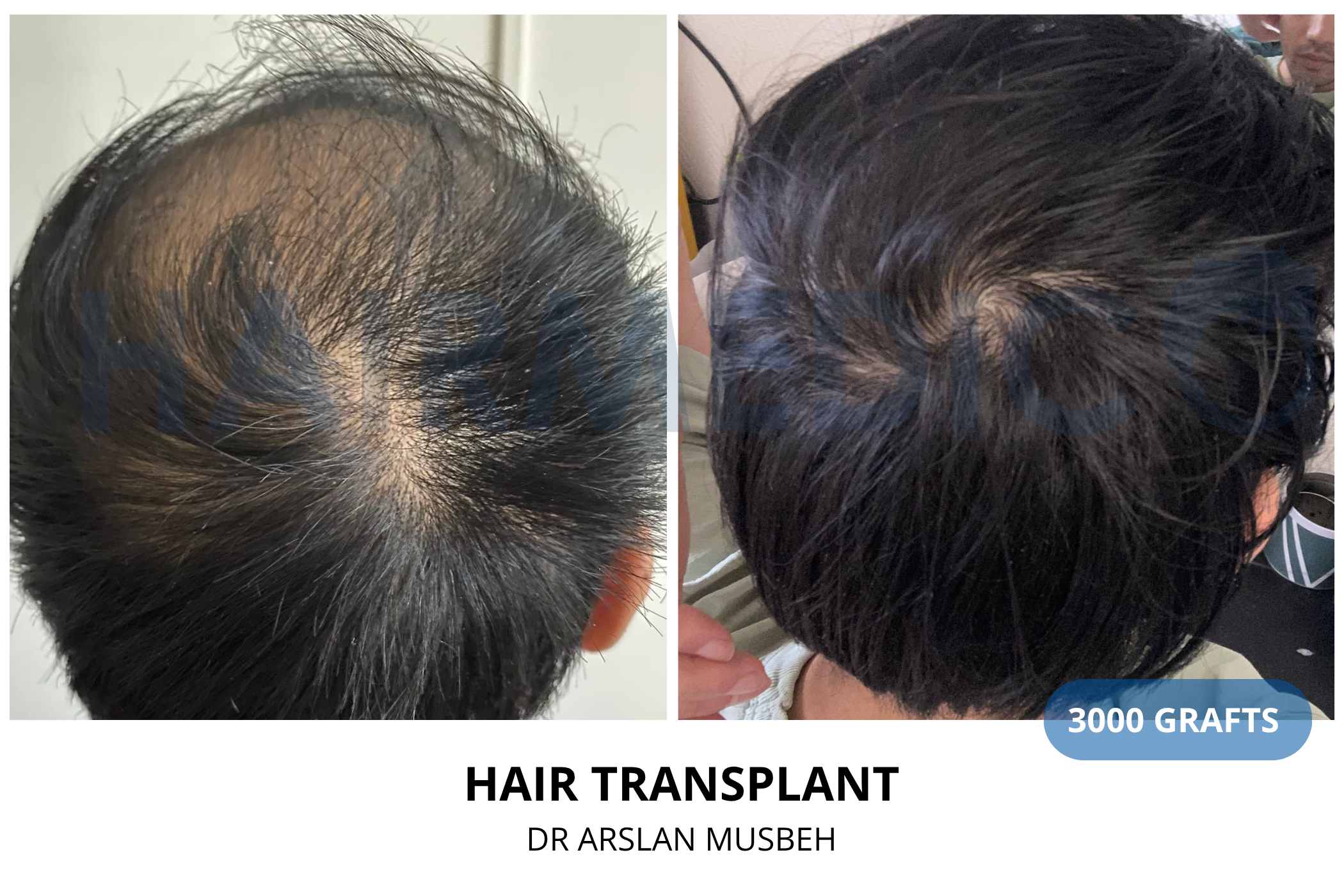 Hair transplant 12-month result — 1925 grafts DHI, Dr. Arslan Musbeh, Hairmedico Istanbul
