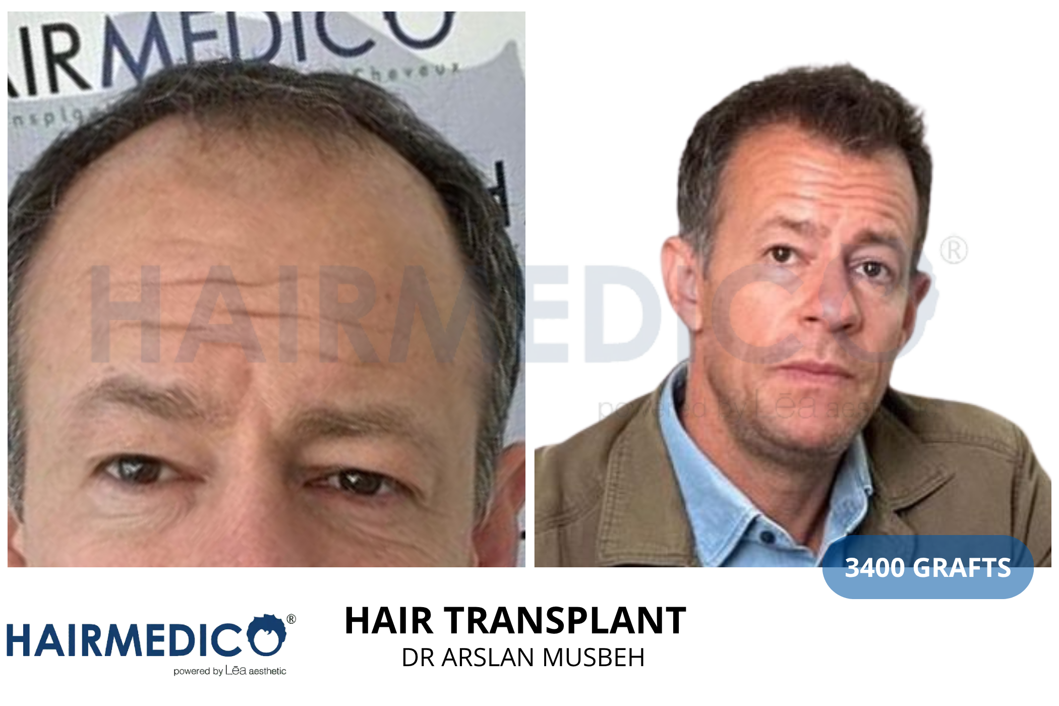 Hair transplant consultation result — 2000 grafts DHI, Dr. Arslan Musbeh, Hairmedico Istanbul