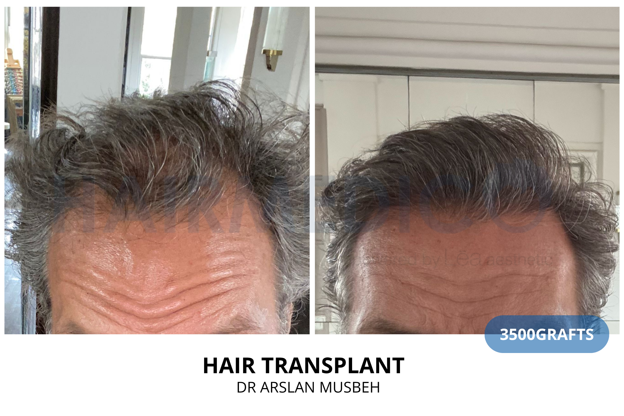 Hair transplant consultation result — 2075 grafts DHI, Dr. Arslan Musbeh, Hairmedico Istanbul
