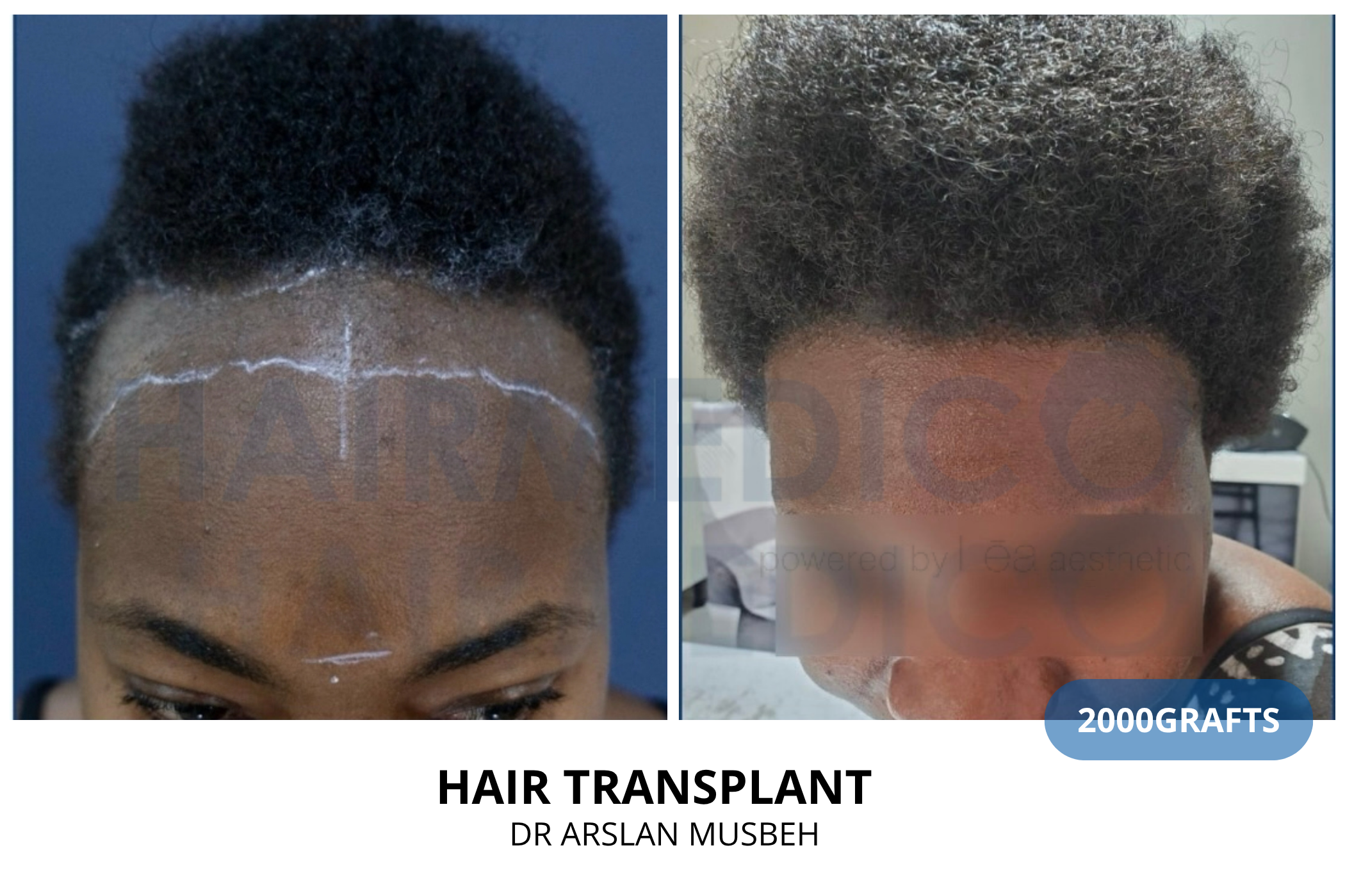 Hair transplant consultation result — 2125 grafts DHI, Dr. Arslan Musbeh, Hairmedico Istanbul