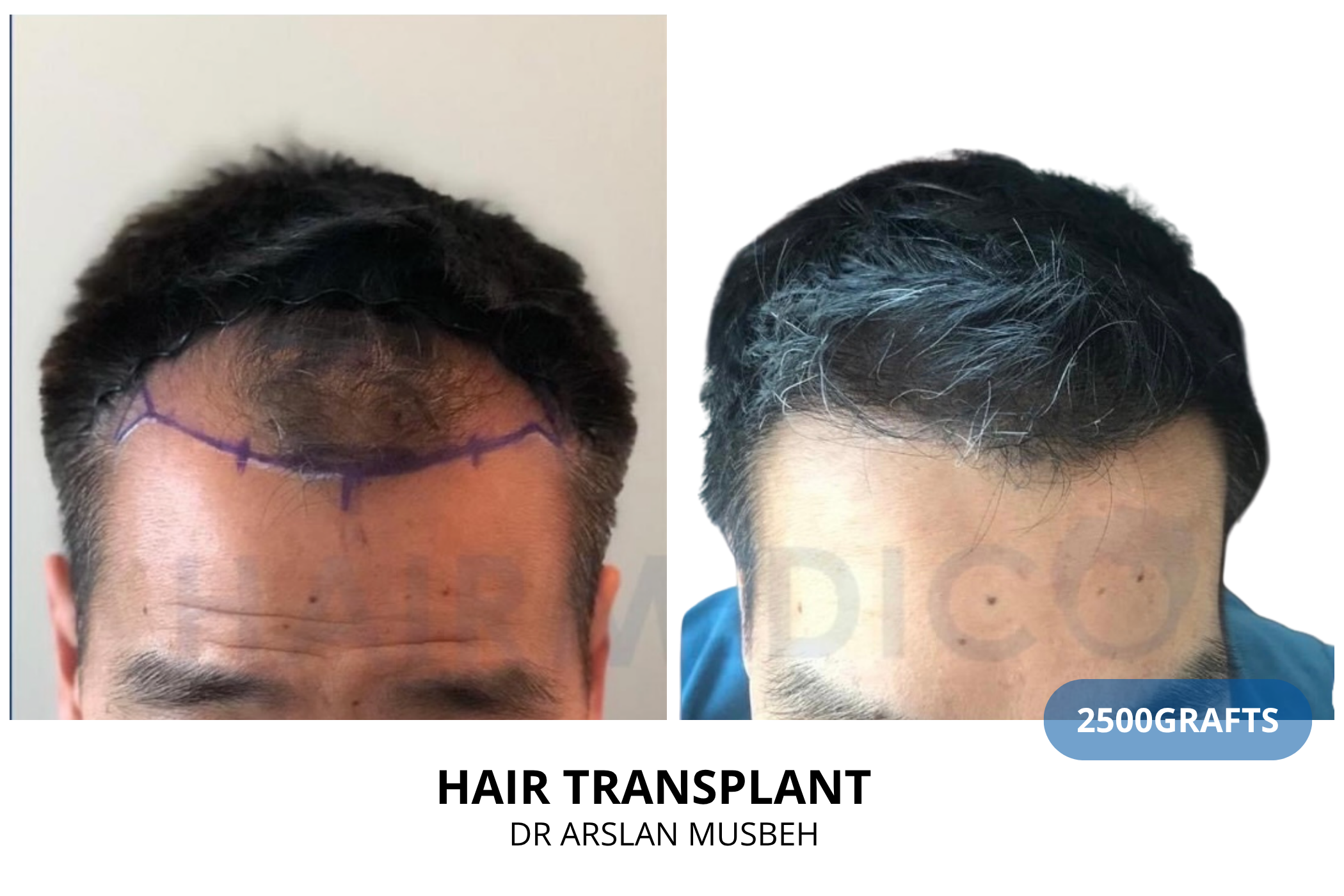 Hair transplant consultation result — 2225 grafts DHI, Dr. Arslan Musbeh, Hairmedico Istanbul