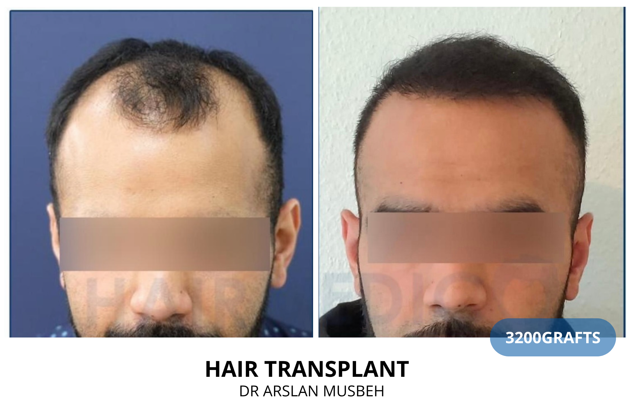 Hair transplant consultation result — 2250 grafts DHI, Dr. Arslan Musbeh, Hairmedico Istanbul