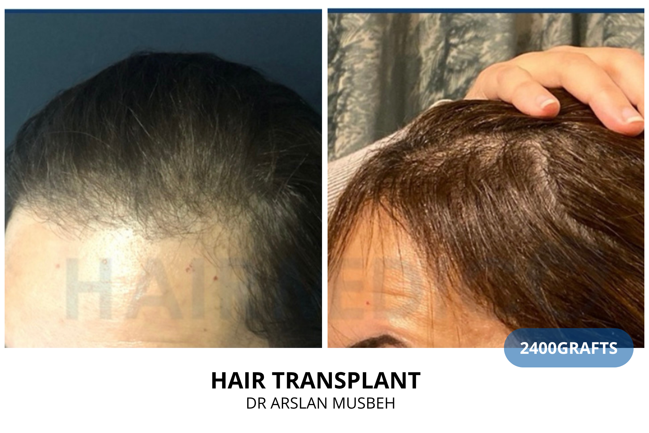 Hair transplant consultation result — 2300 grafts DHI, Dr. Arslan Musbeh, Hairmedico Istanbul