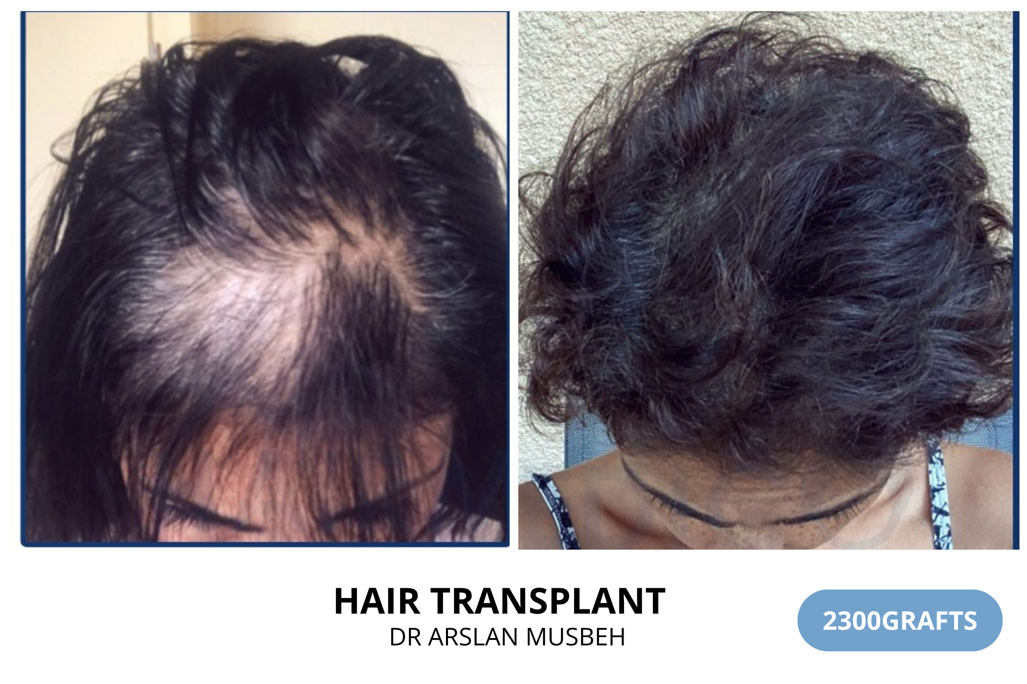 Hair transplant consultation result — 2425 grafts DHI, Dr. Arslan Musbeh, Hairmedico Istanbul
