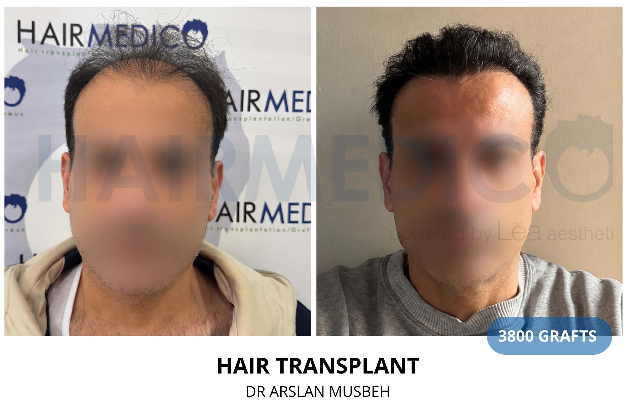 Hair transplant 3-month result — 460 grafts FUE, Dr. Arslan Musbeh, Hairmedico Istanbul