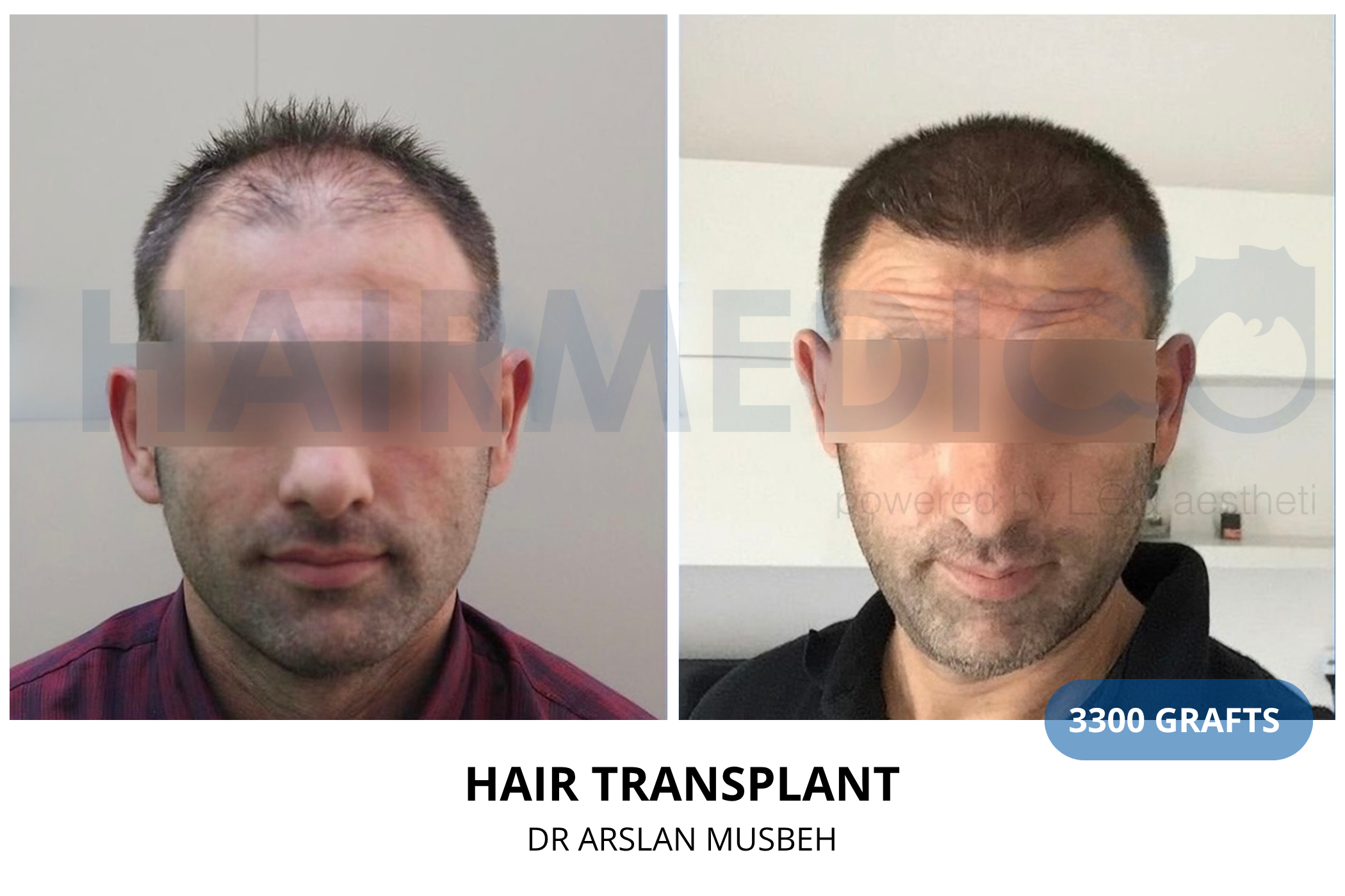 Hair transplant 3-month result — 520 grafts FUE, Dr. Arslan Musbeh, Hairmedico Istanbul