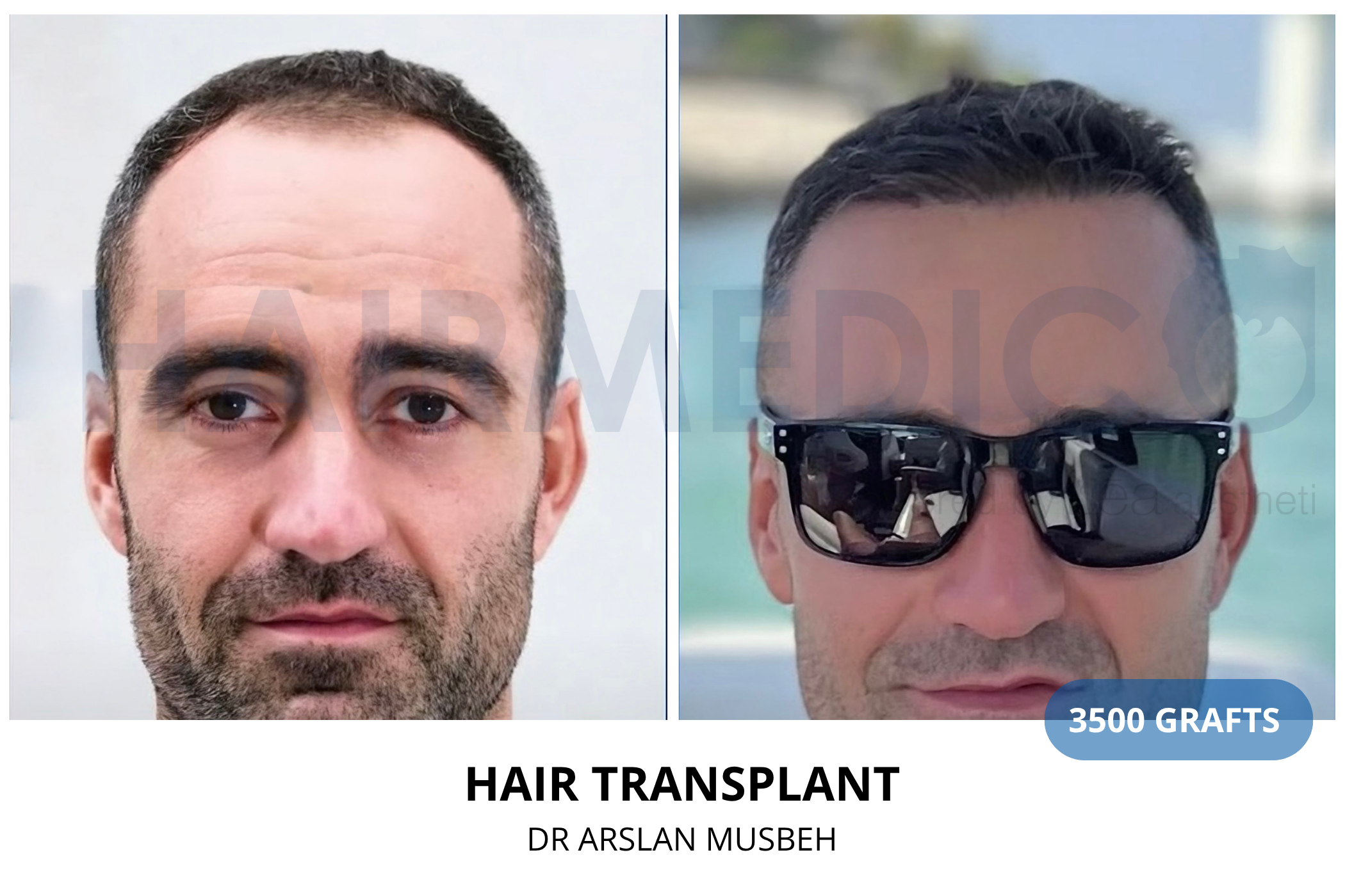 Hair transplant 3-month result — 550 grafts FUE, Dr. Arslan Musbeh, Hairmedico Istanbul