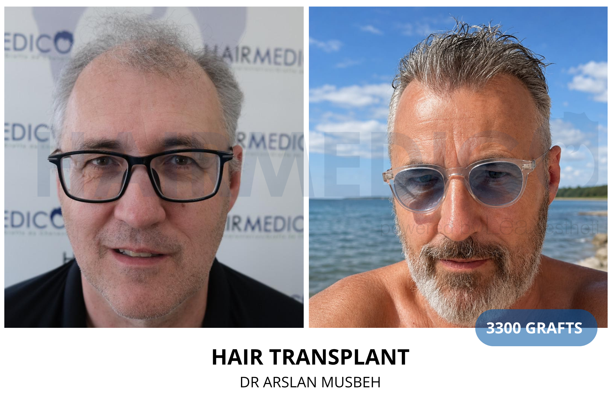 Hair transplant 3-month result — 580 grafts FUE, Dr. Arslan Musbeh, Hairmedico Istanbul