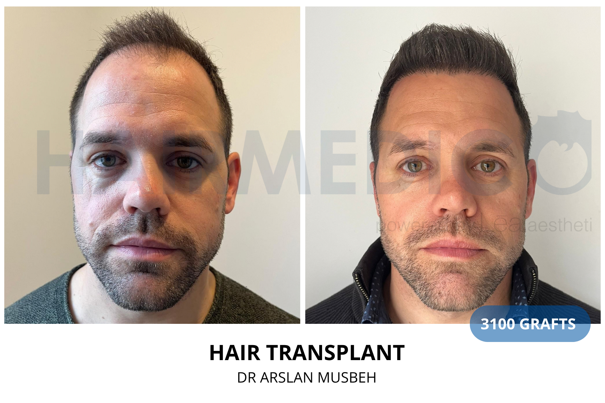 Hair transplant 3-month result — 610 grafts FUE, Dr. Arslan Musbeh, Hairmedico Istanbul