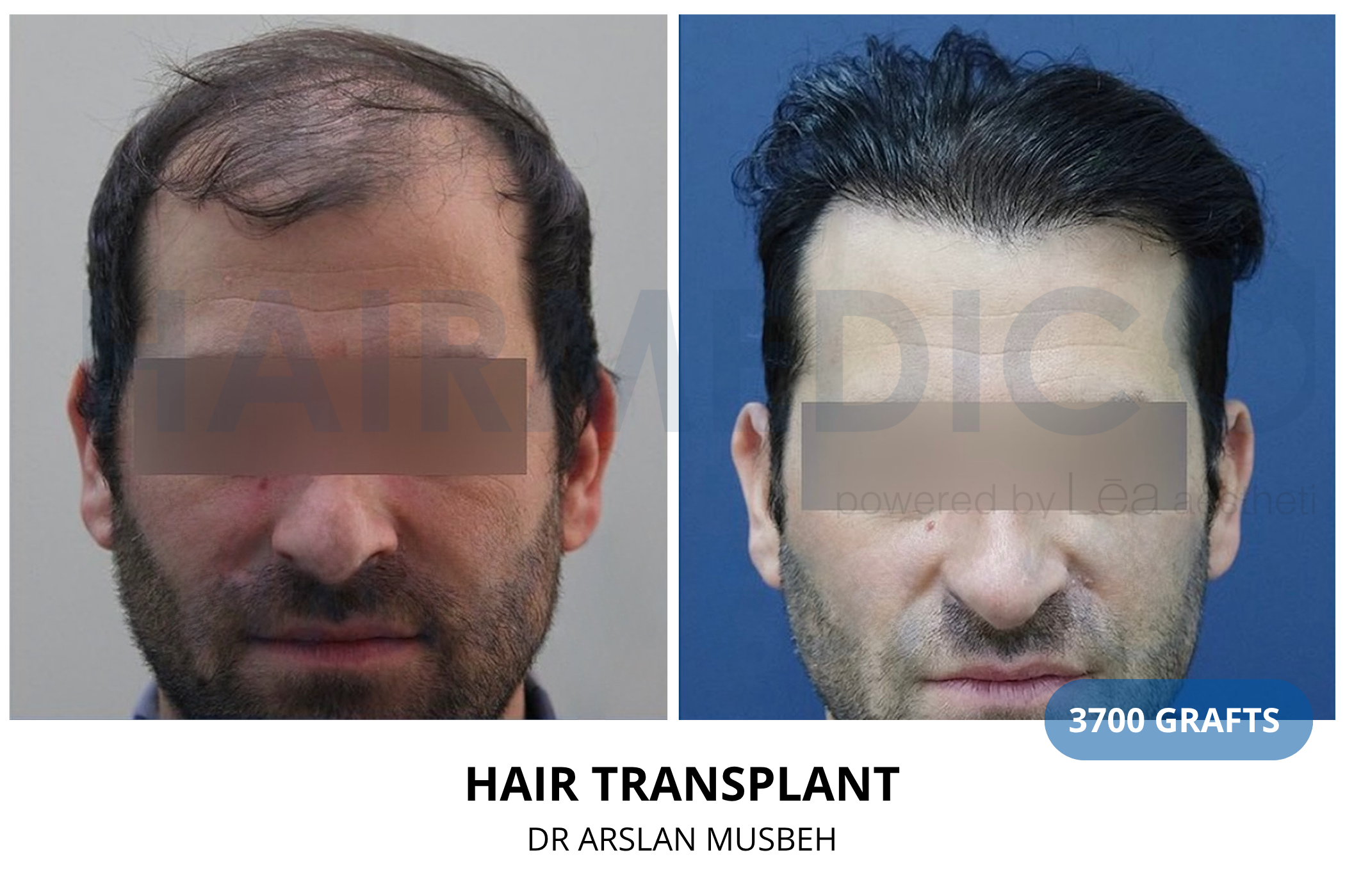 Hair transplant 3-month result — 640 grafts FUE, Dr. Arslan Musbeh, Hairmedico Istanbul