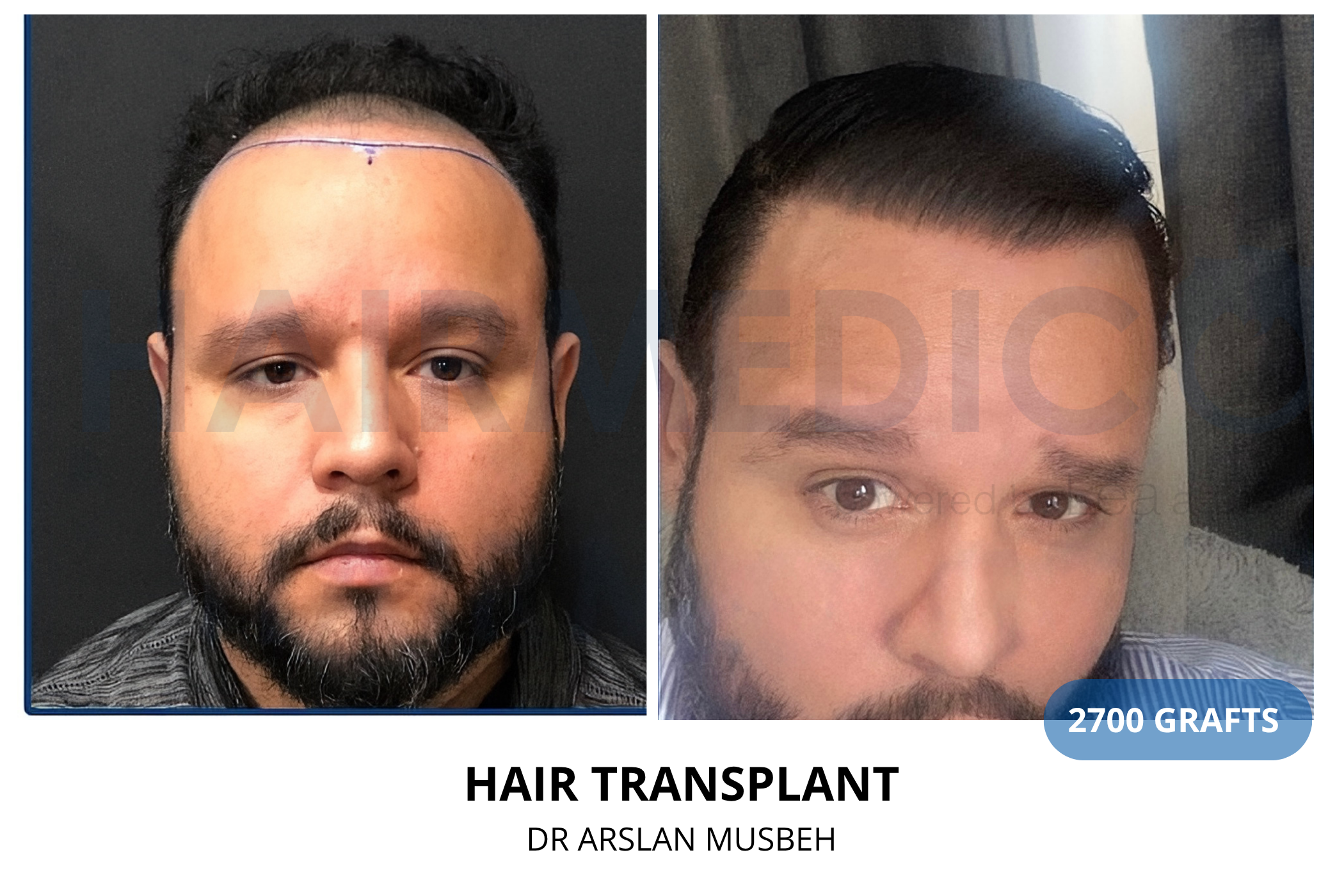 Hair transplant 3-month result — 700 grafts FUE, Dr. Arslan Musbeh, Hairmedico Istanbul