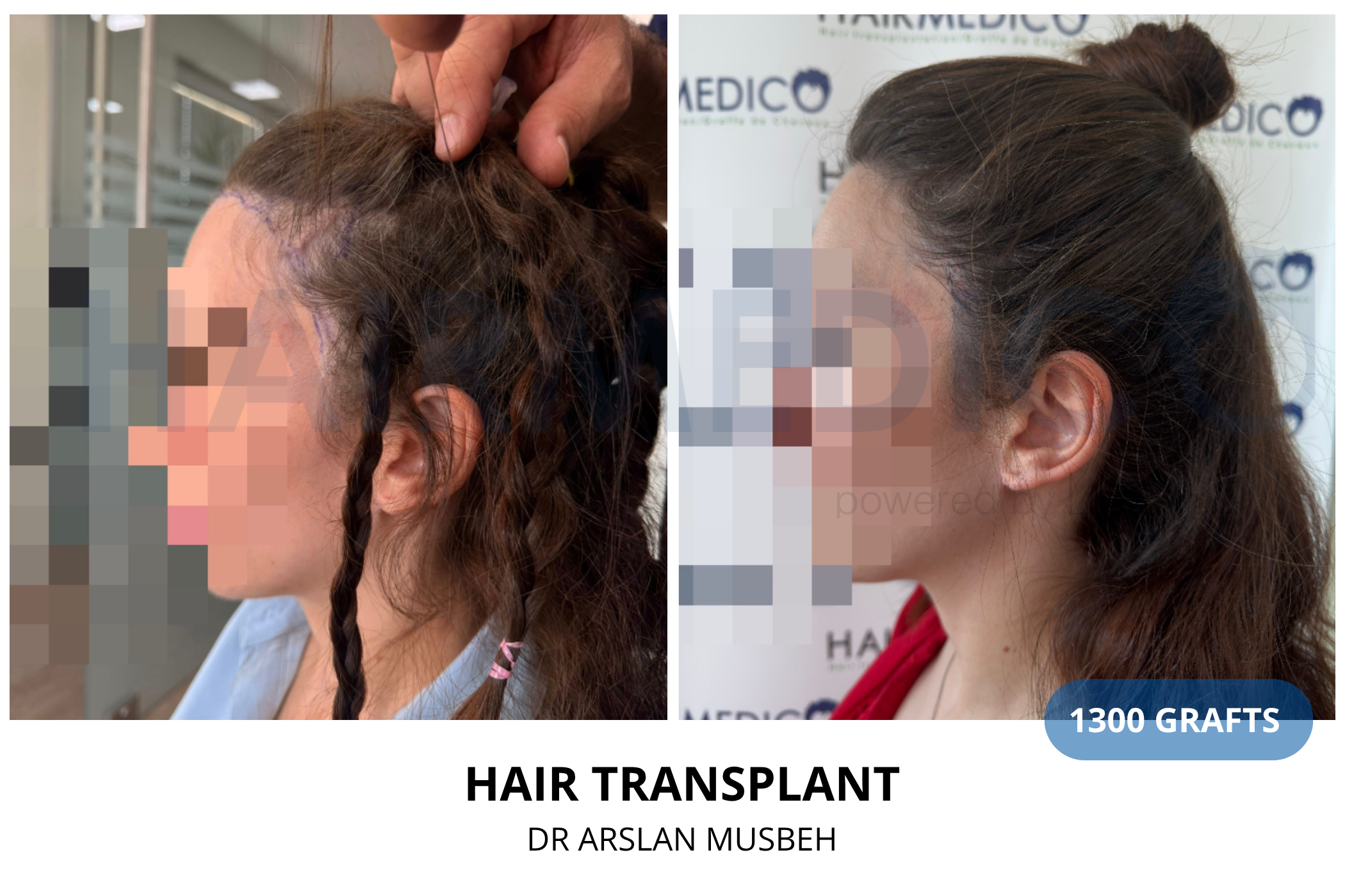 Hair transplant 3-month result — 730 grafts FUE, Dr. Arslan Musbeh, Hairmedico Istanbul