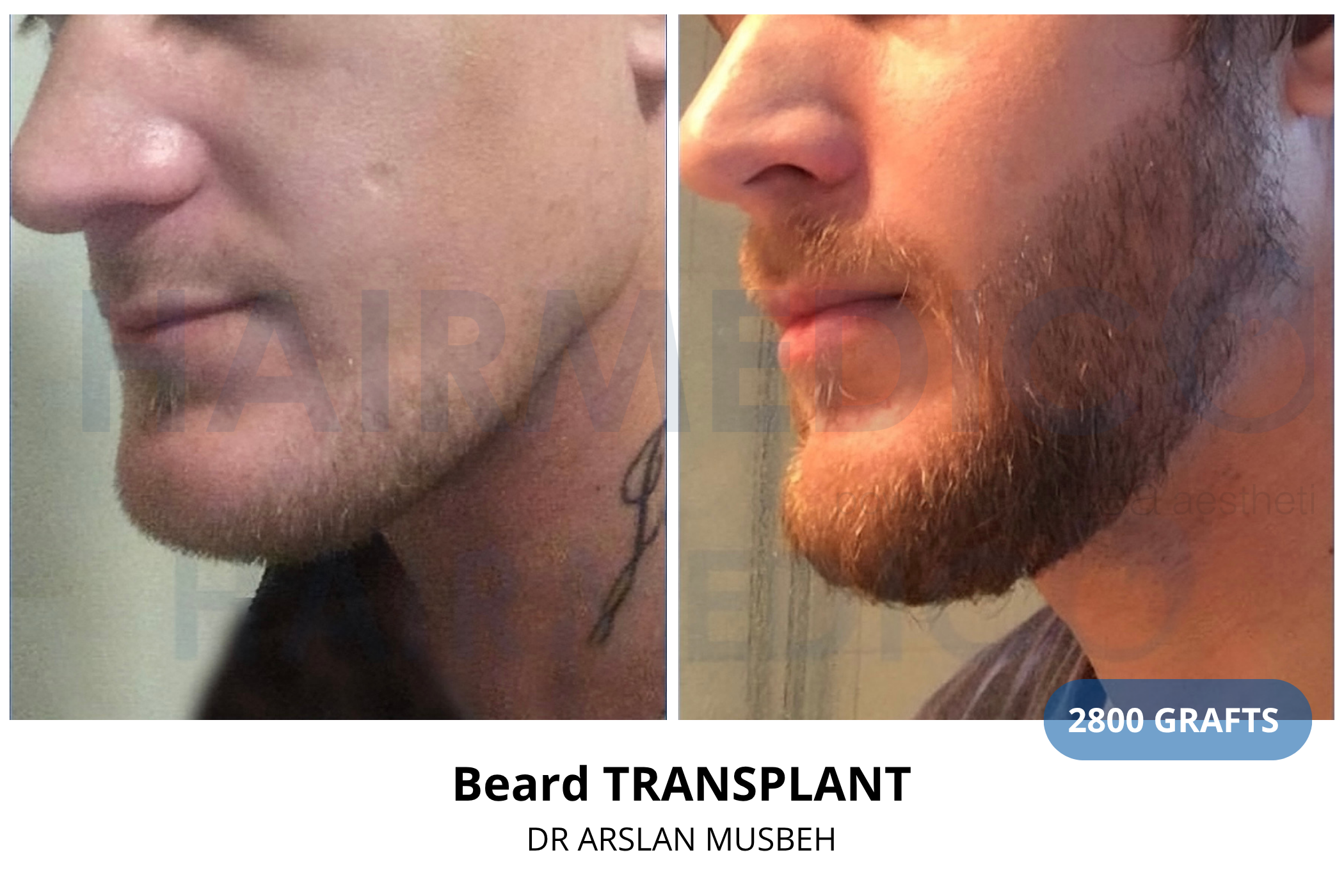 Hair transplant 3-month result — 760 grafts FUE, Dr. Arslan Musbeh, Hairmedico Istanbul