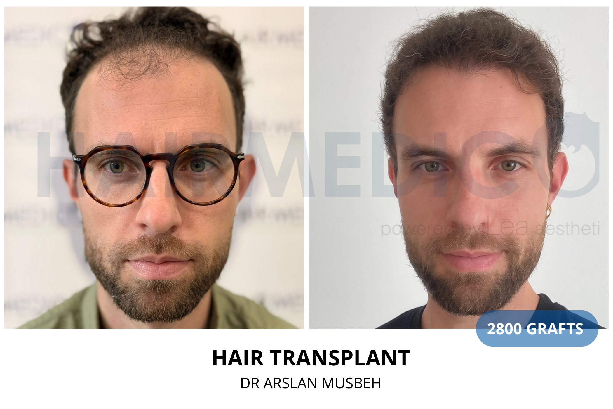 Hair transplant 3-month result — 820 grafts FUE, Dr. Arslan Musbeh, Hairmedico Istanbul