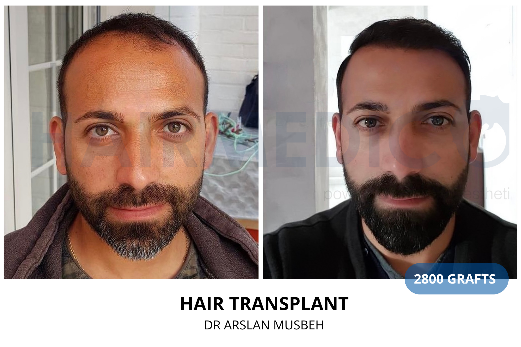 Hair transplant 3-month result — 880 grafts FUE, Dr. Arslan Musbeh, Hairmedico Istanbul