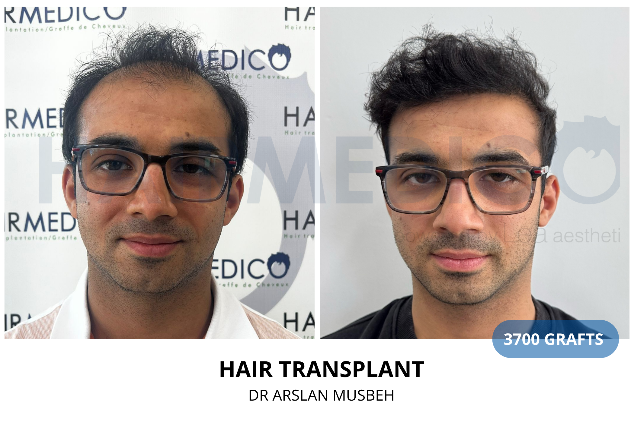 Hair transplant 3-month result — 910 grafts FUE, Dr. Arslan Musbeh, Hairmedico Istanbul