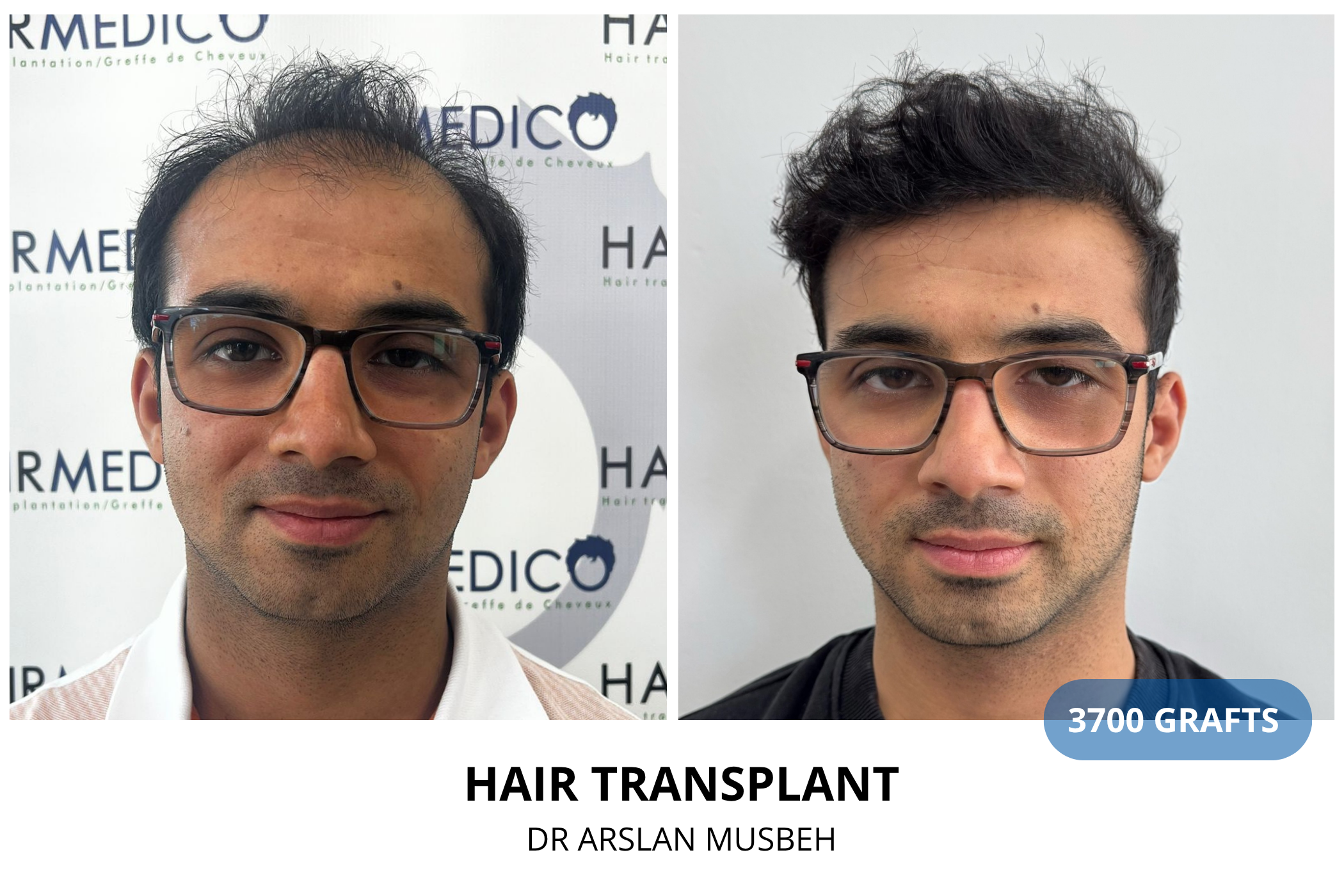 Hair transplant 3-month result — 940 grafts FUE, Dr. Arslan Musbeh, Hairmedico Istanbul