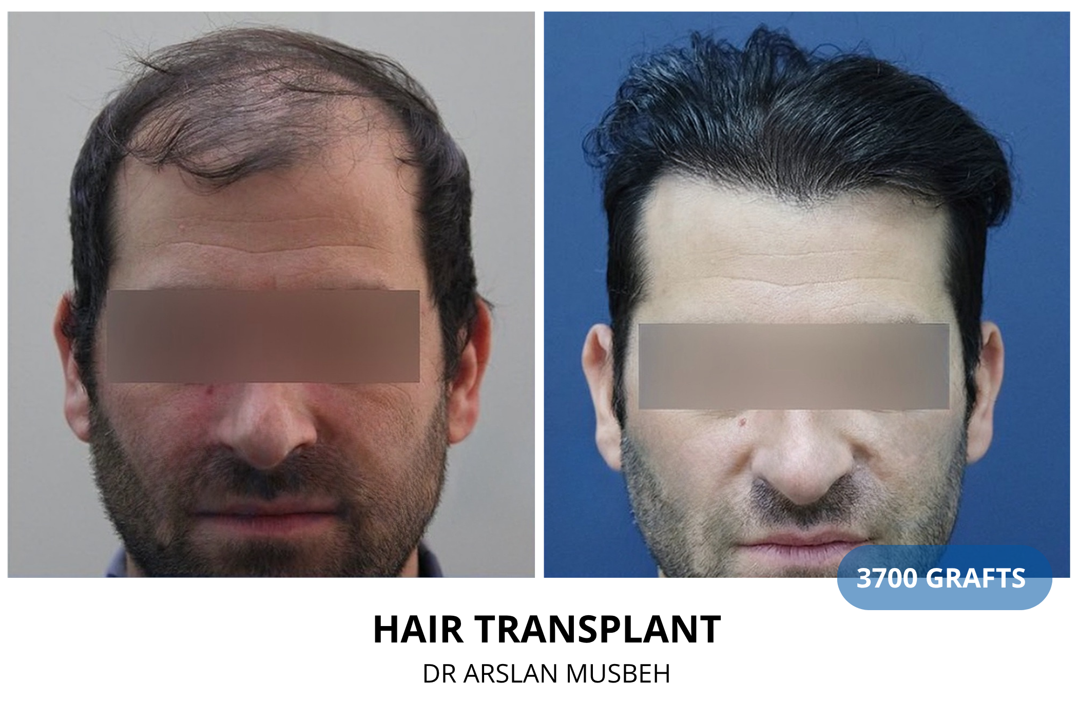 Hair transplant 3-month result — 970 grafts FUE, Dr. Arslan Musbeh, Hairmedico Istanbul