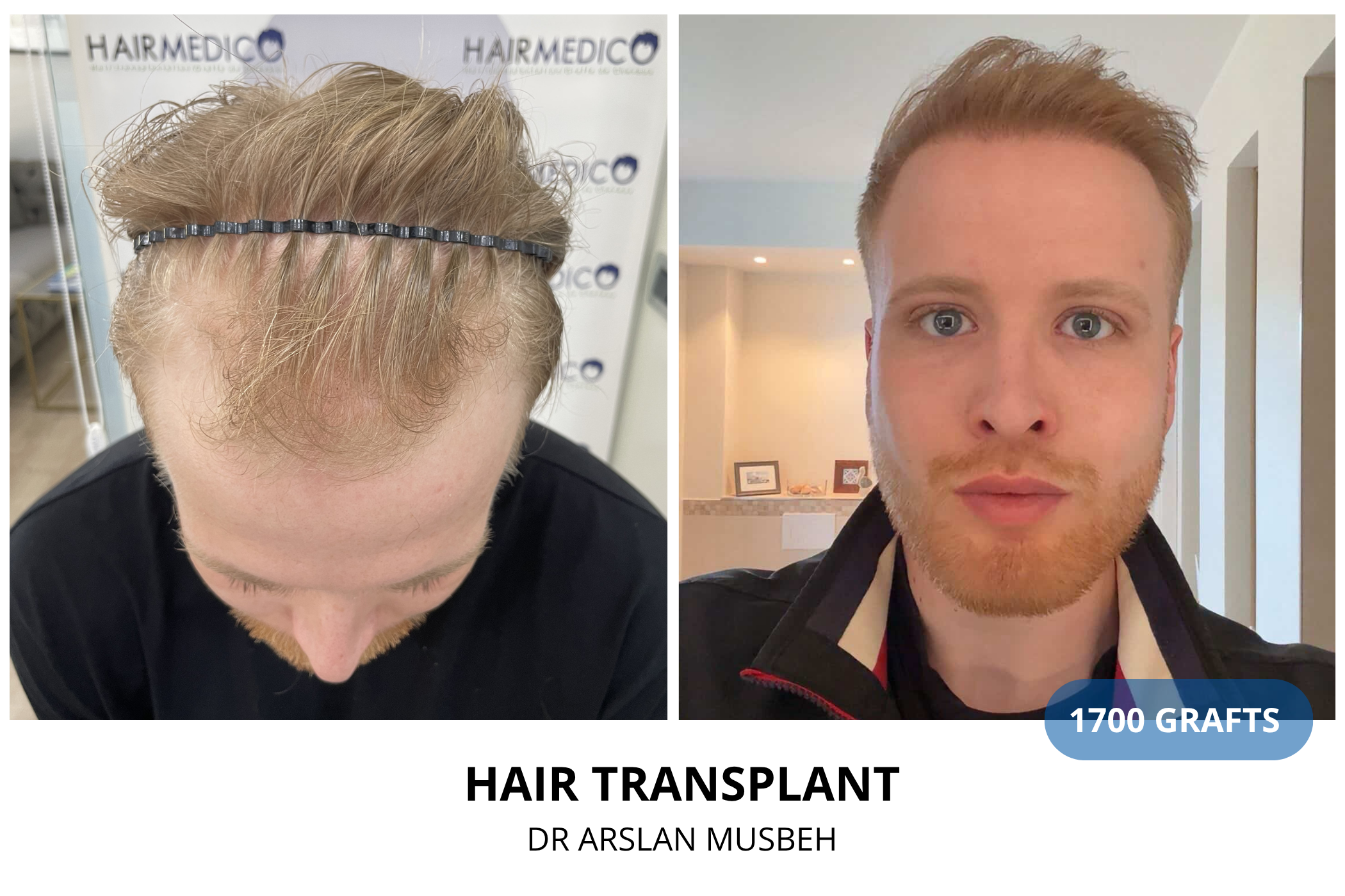 Hair transplant 6-month result — 975 grafts FUE, Dr. Arslan Musbeh, Hairmedico Istanbul