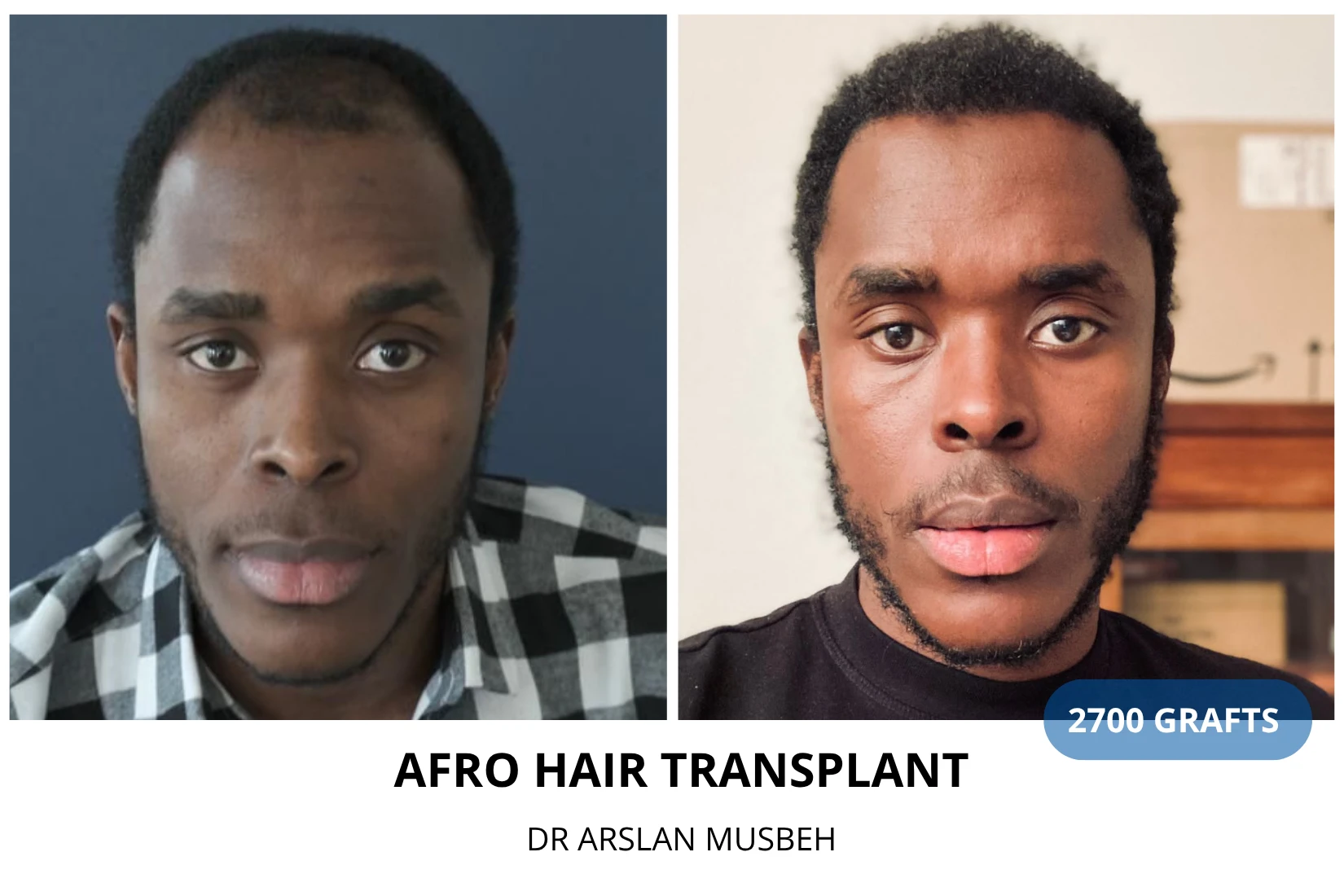 Hair transplant 2700 grafts FUE before and after at Hairmedico clinic by Dr. Arslan Musbeh in Istanbul