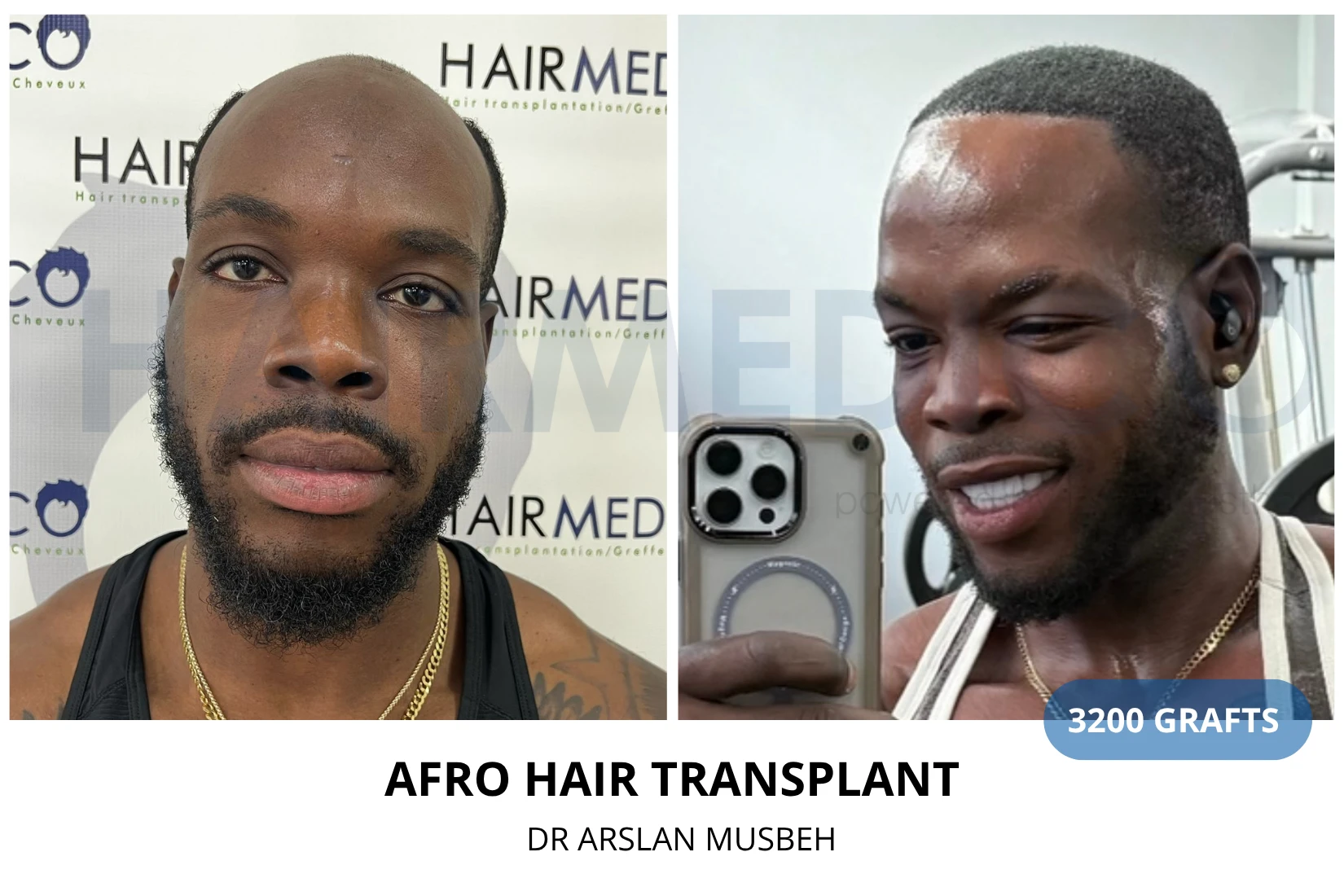 Hair transplant 3200 grafts FUE before and after at Hairmedico clinic by Dr. Arslan Musbeh in Istanbul