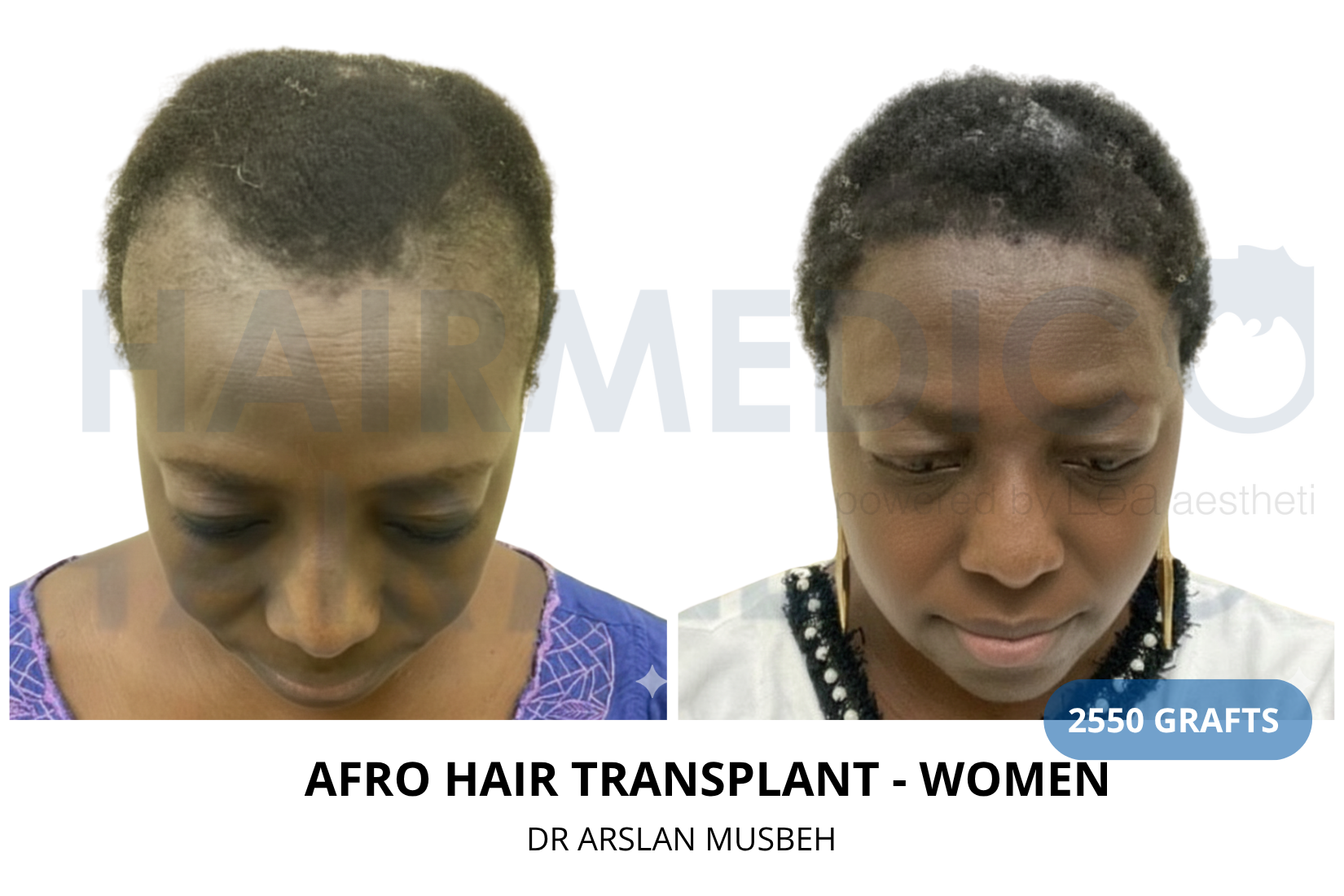 Risultato trapianto di capelli AFRO, 2550 graft, Dr. Arslan Musbeh