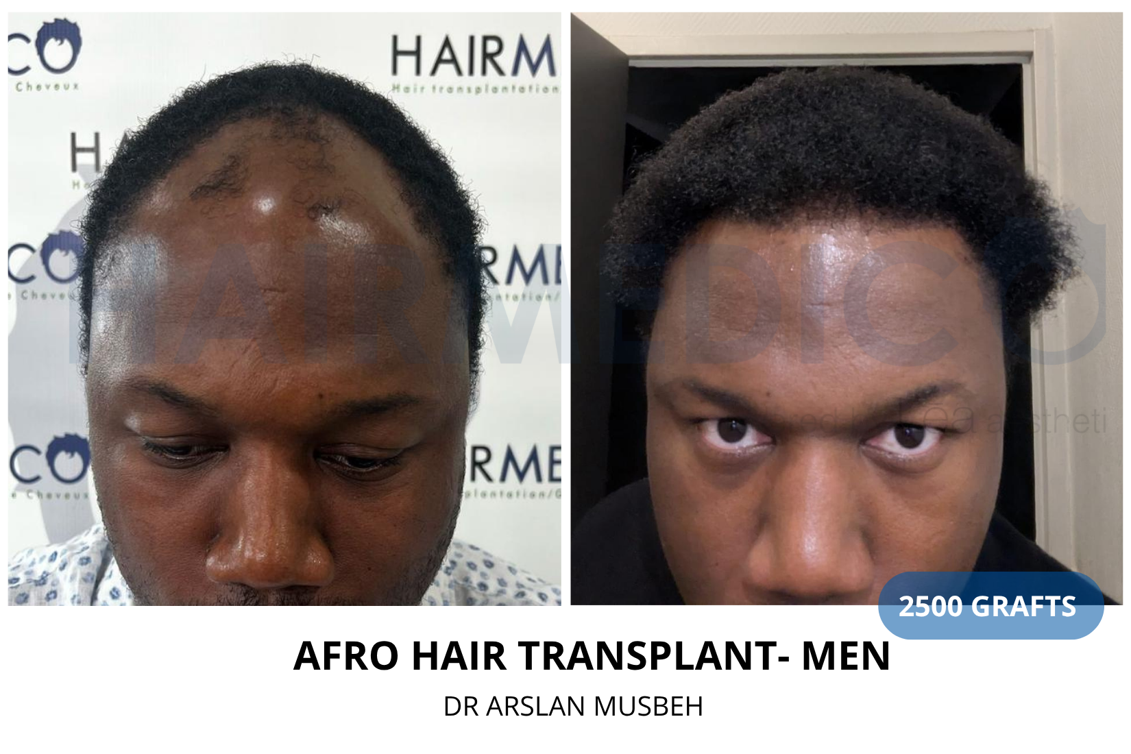 Risultato trapianto di capelli AFRO, 2500 graft, Dr. Arslan Musbeh