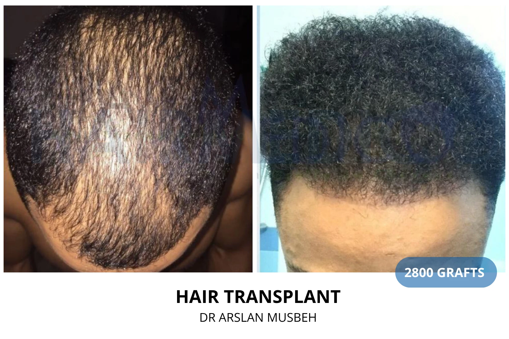 Hair transplant 2900 grafts FUE before and after at Hairmedico clinic by Dr. Arslan Musbeh in Istanbul