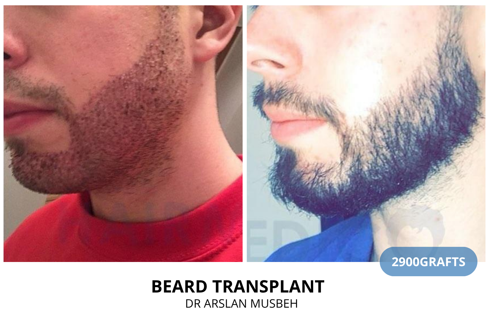 Risultato trapianto di barba, 2900 graft, Dr. Arslan Musbeh